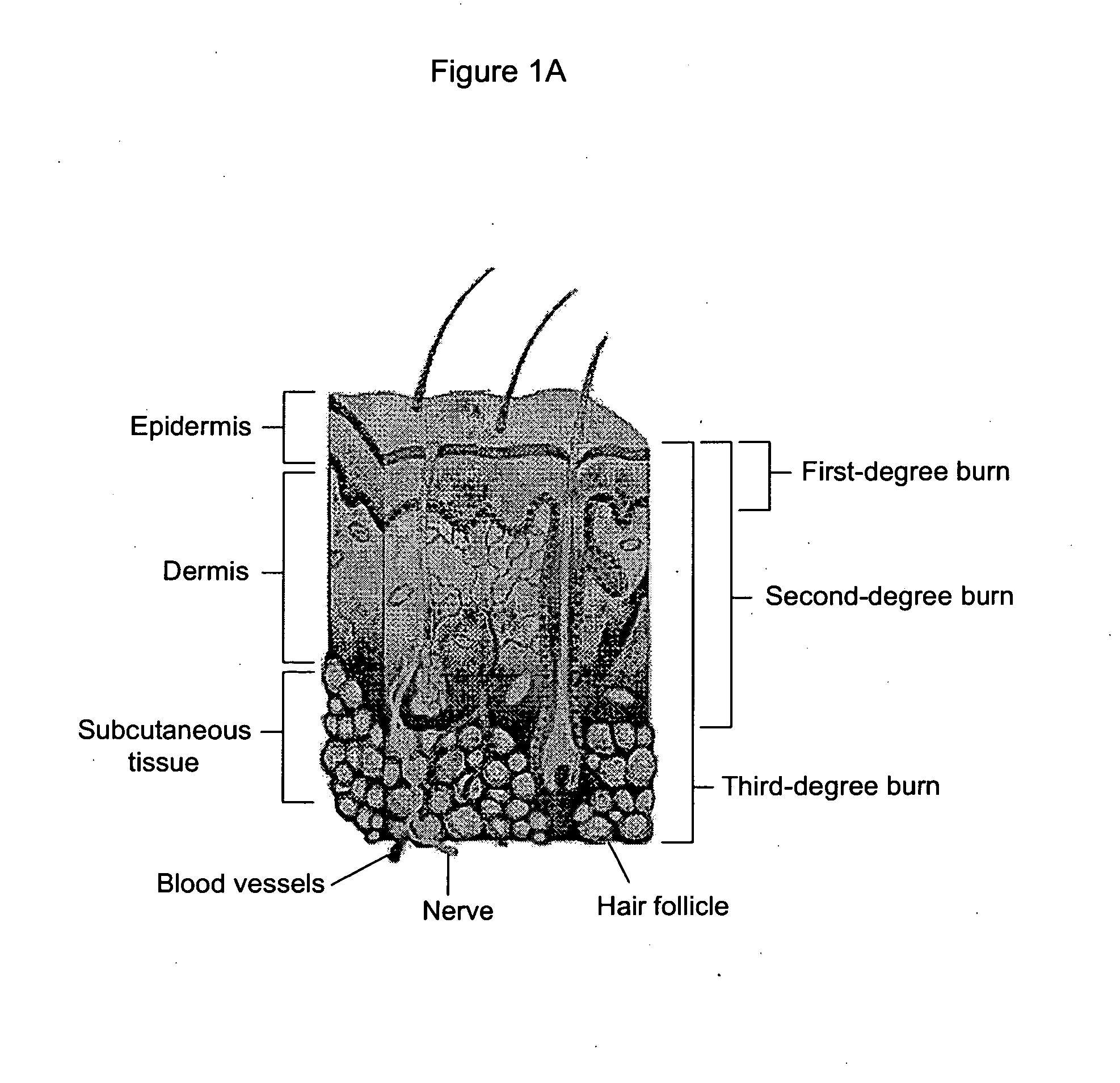 Compositions and Methods for Treating Burns