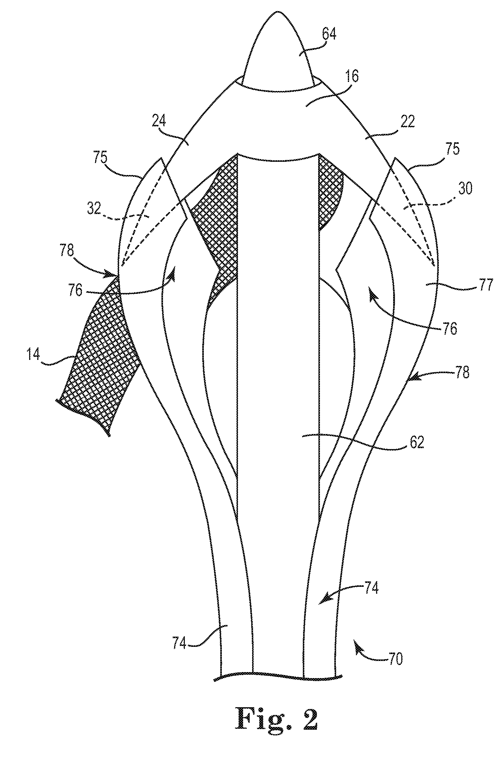 Pelvic implant and delivery system