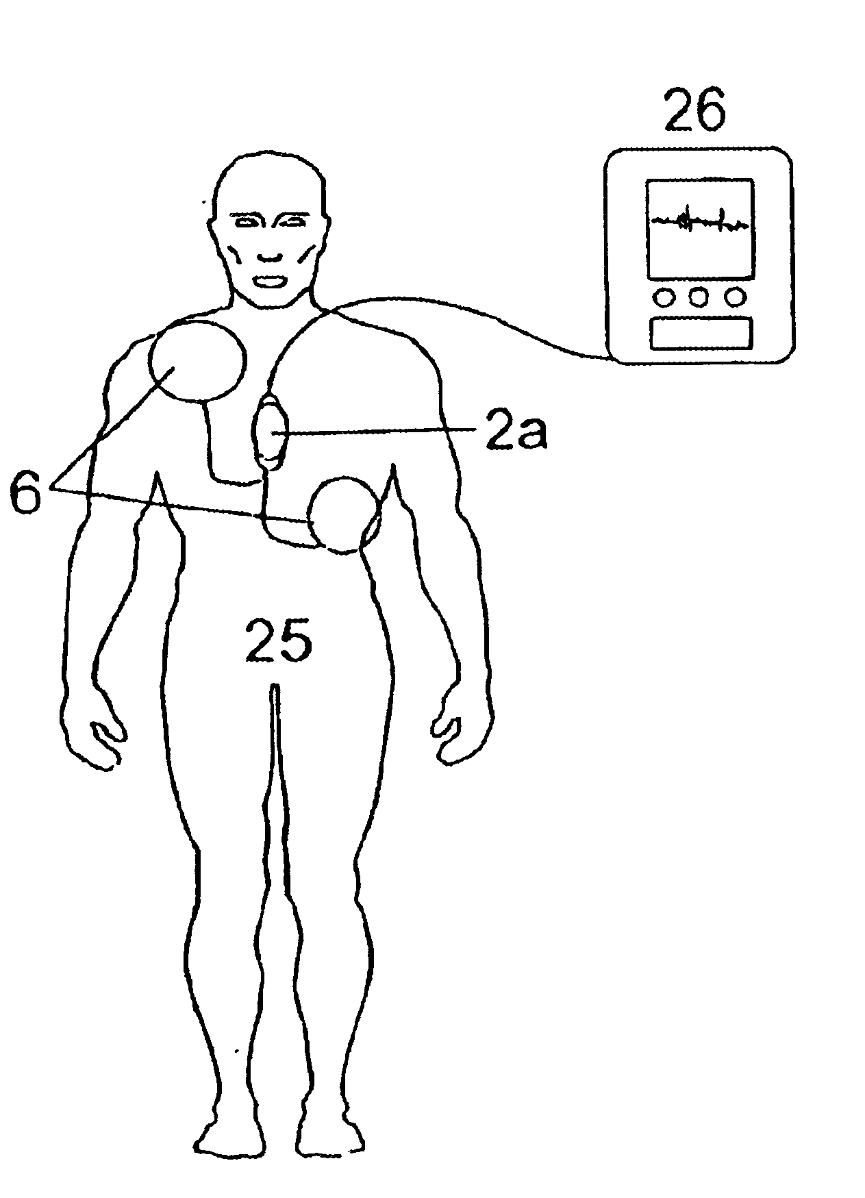 System for reducing signal disturbances in ECG, which disturbances are caused by cardio-pulmonary resuscitation