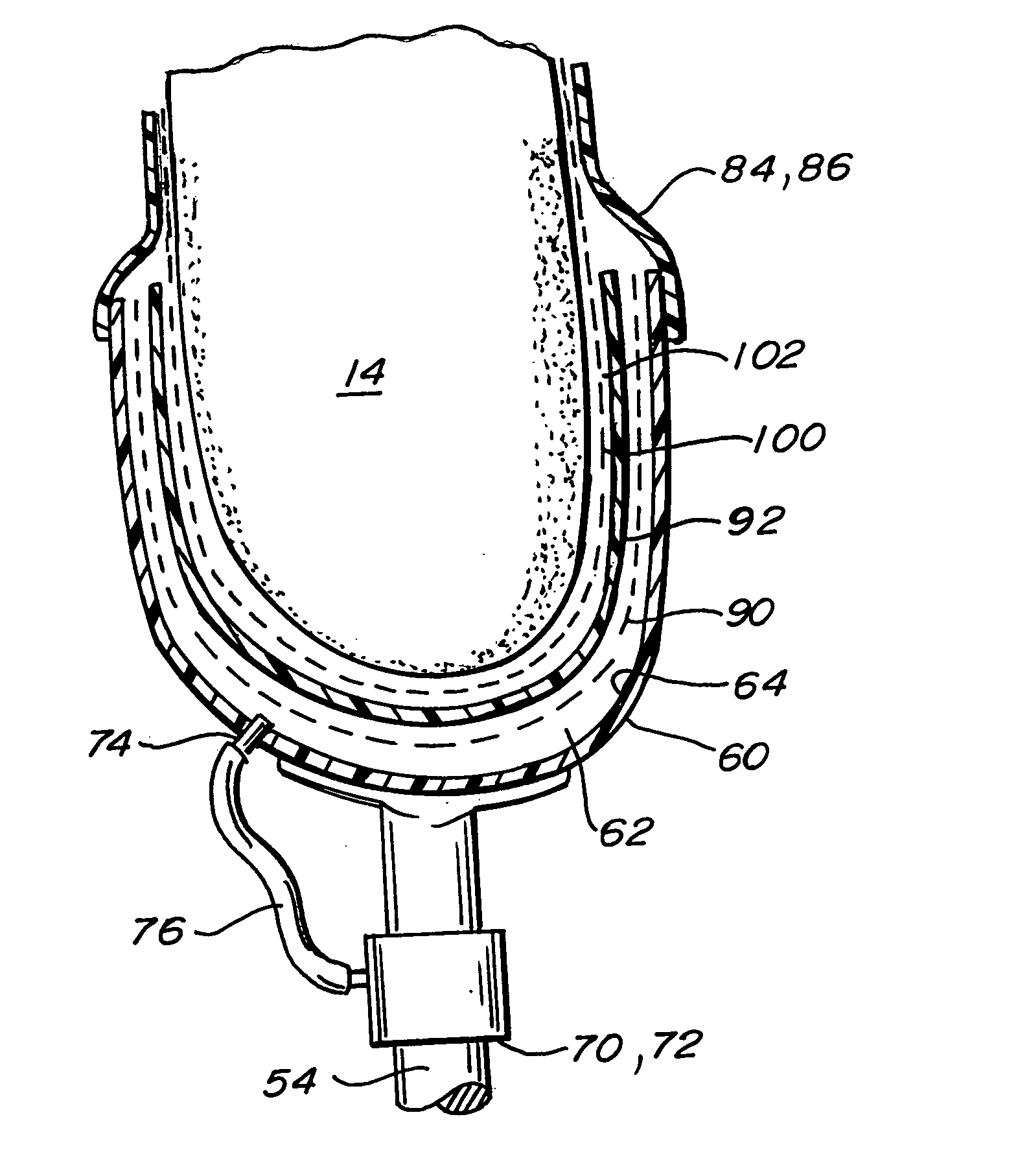 Osmotic membrane and vacuum system for artificial limb