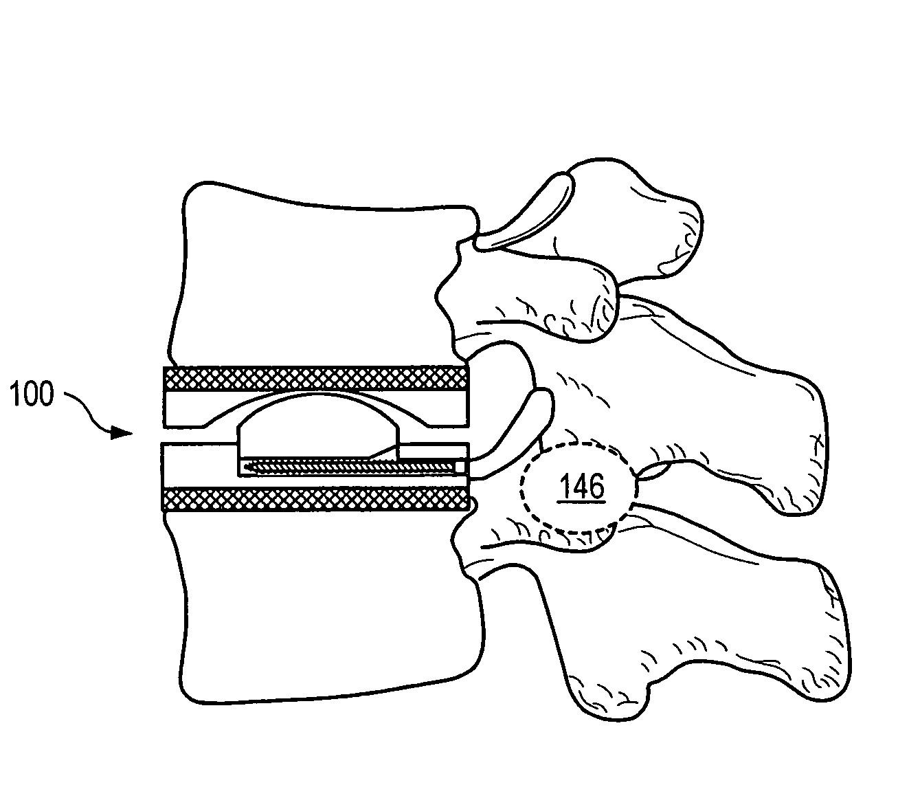 Expandable articulating intervertebral implant