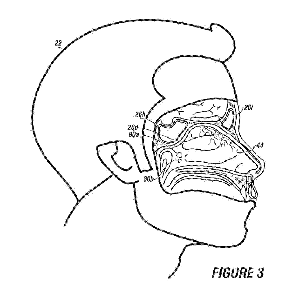 System & method for matching the results of a CT scan to a nasal-sinus surgery plan to treat migraine headaches