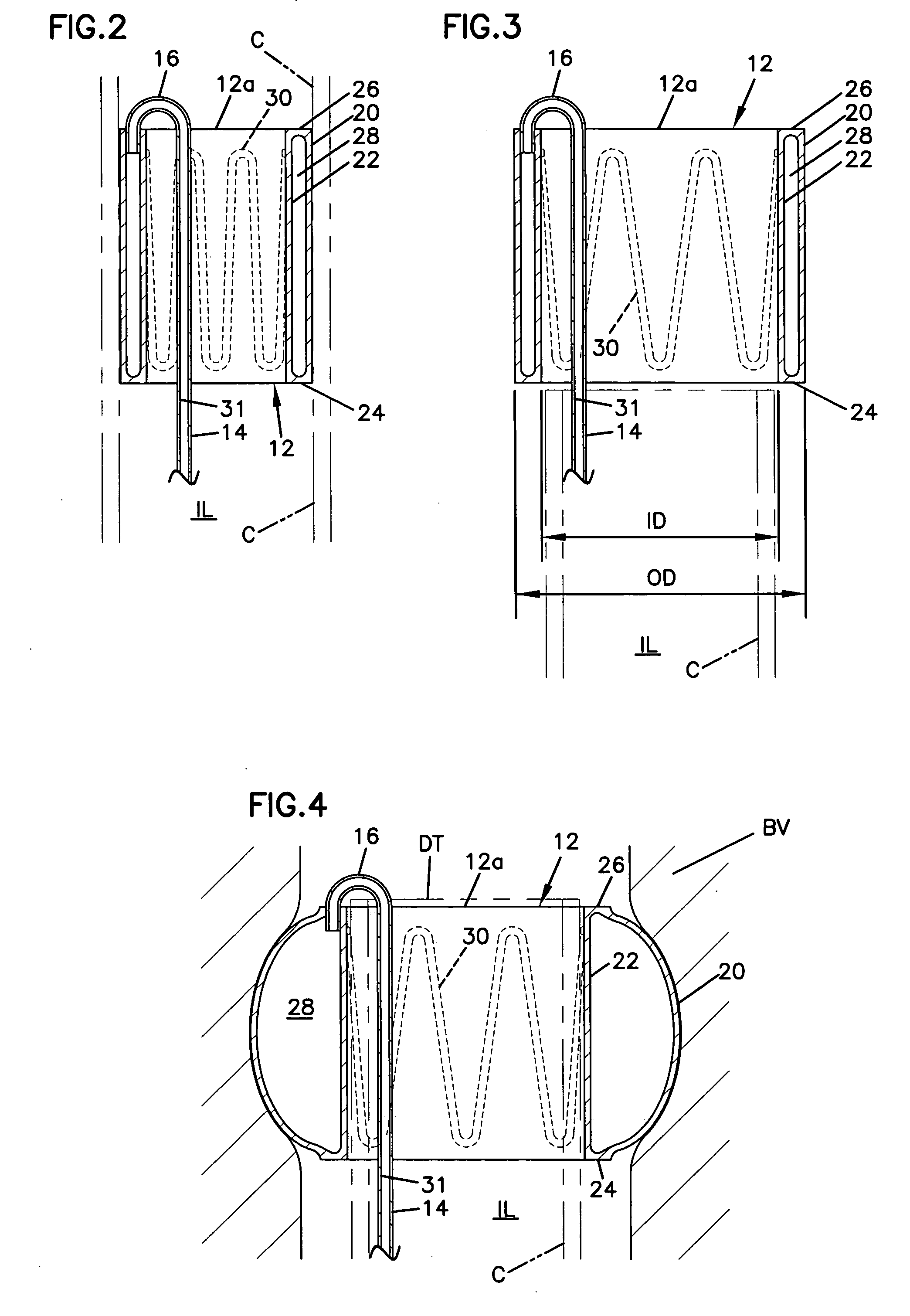 Rapid balloon coupling system