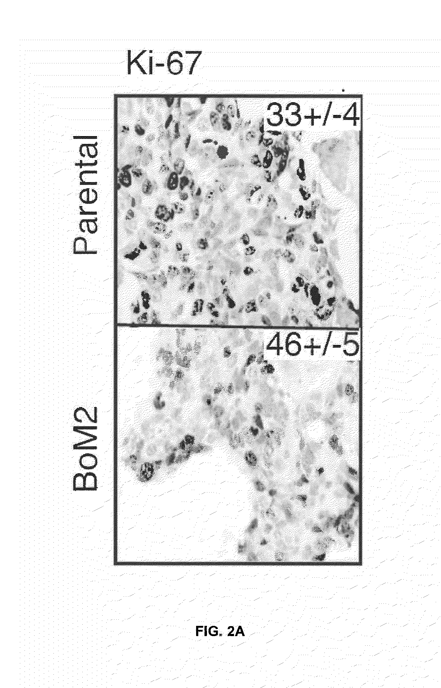 Method for the diagnosis, prognosis and treatment of cancer metastasis