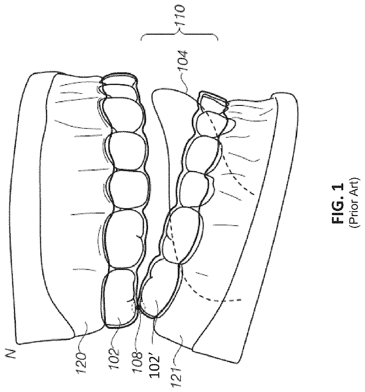 Dental appliance features for speech enhancement