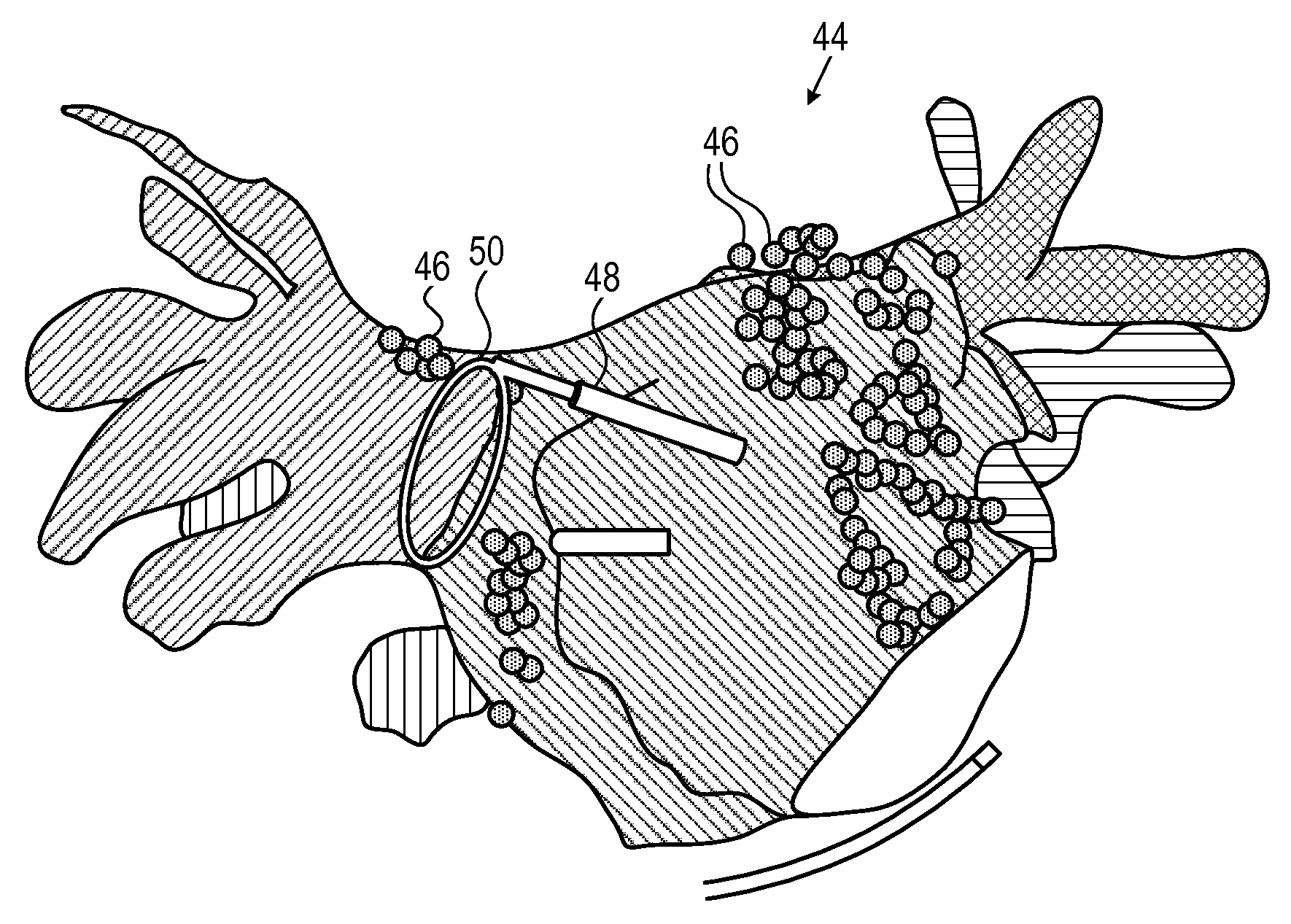 Model based reconstruction of the heart from sparse samples