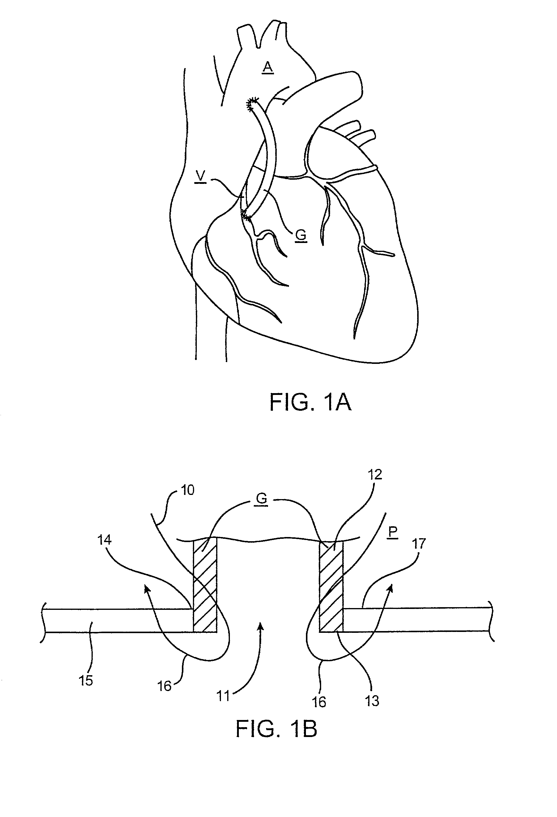 Device and method for performing end-to-side anastomosis