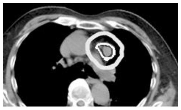 Tumor radiotherapy control system and storage medium