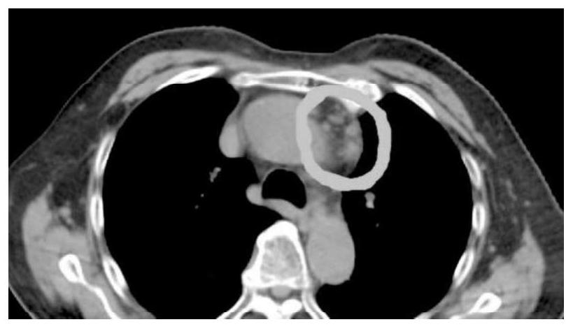 Tumor radiotherapy control system and storage medium