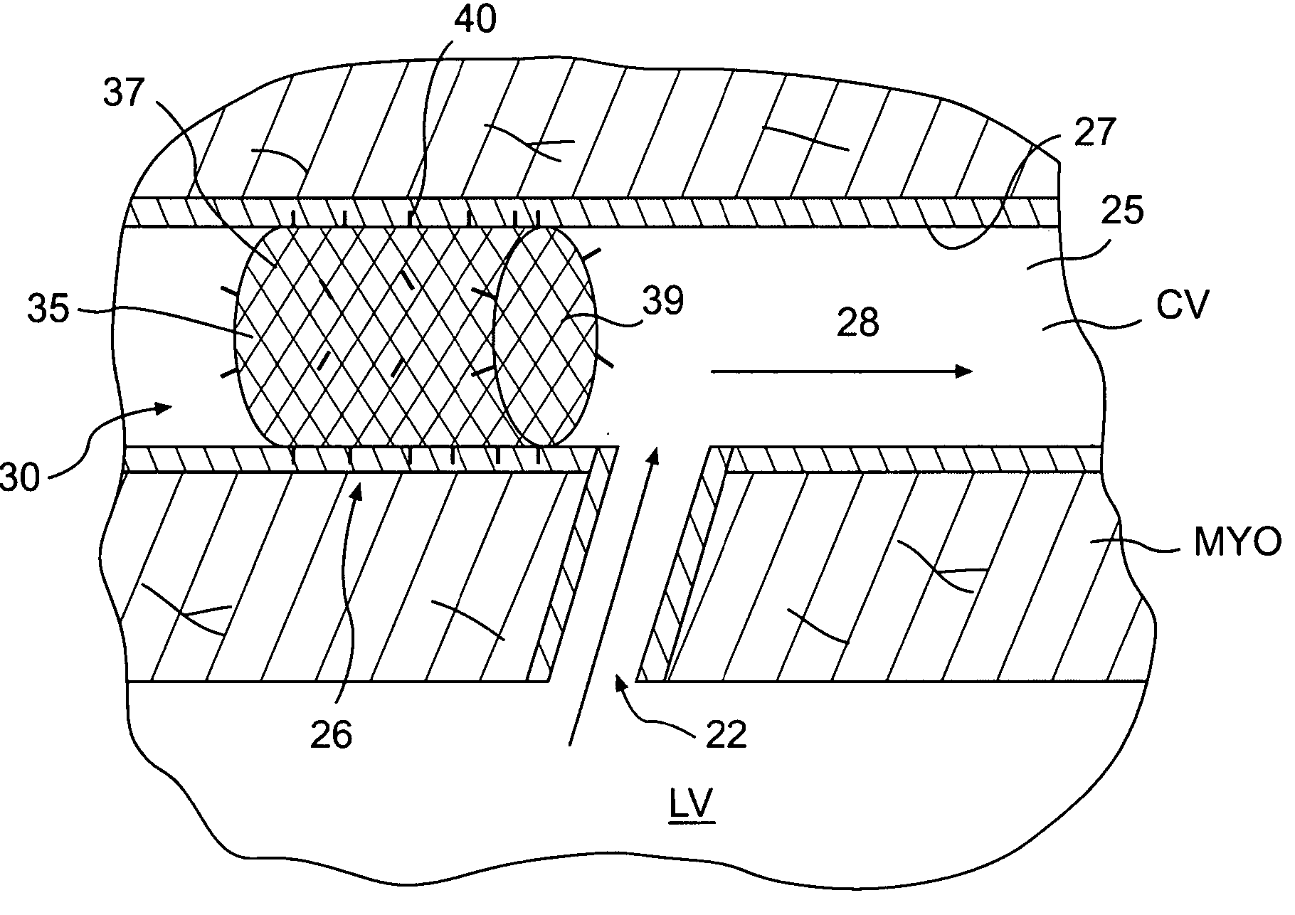 Methods of retroperfusion and related devices