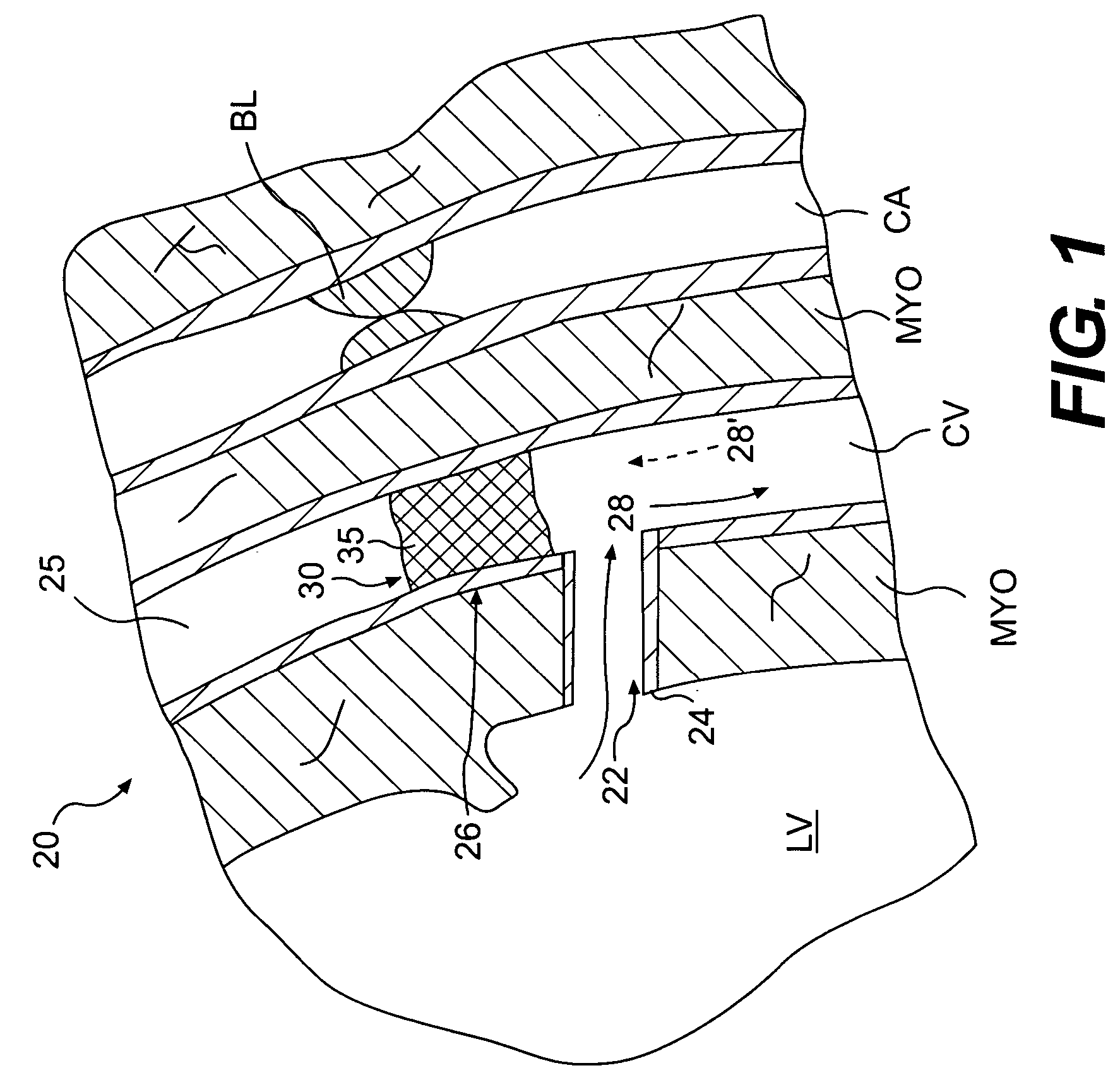 Methods of retroperfusion and related devices