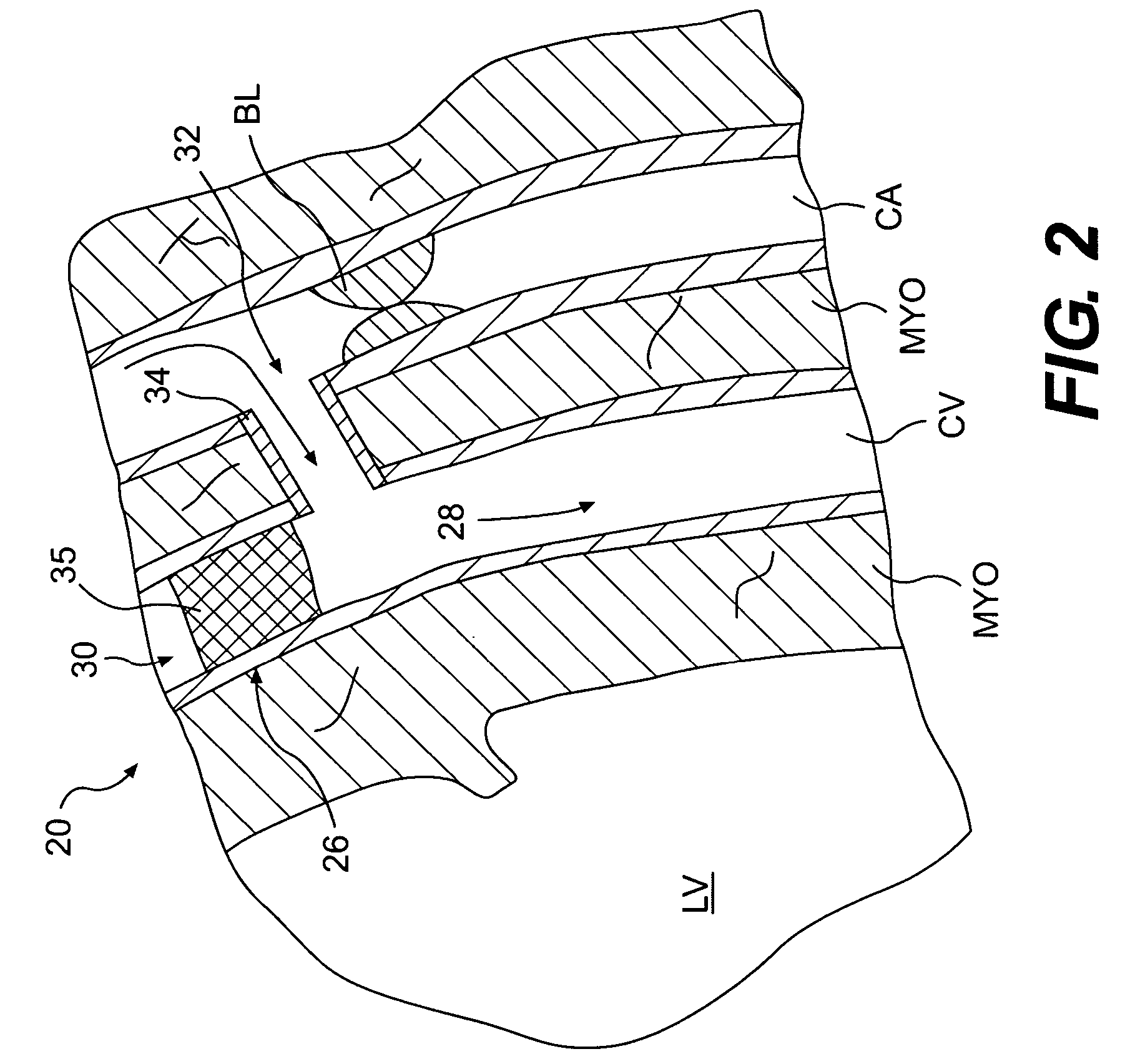 Methods of retroperfusion and related devices