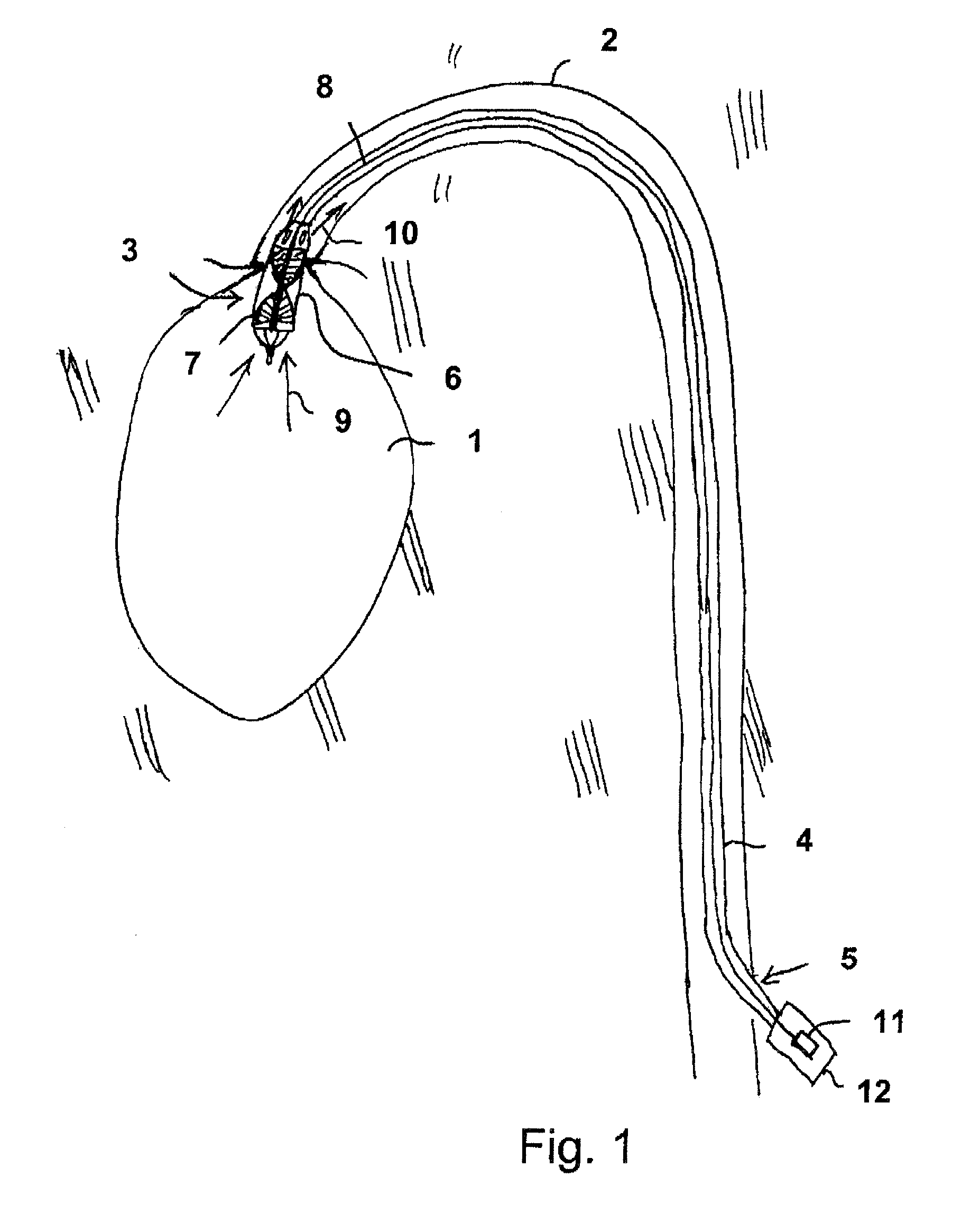 Fluid pump changeable in diameter, in particular for medical application