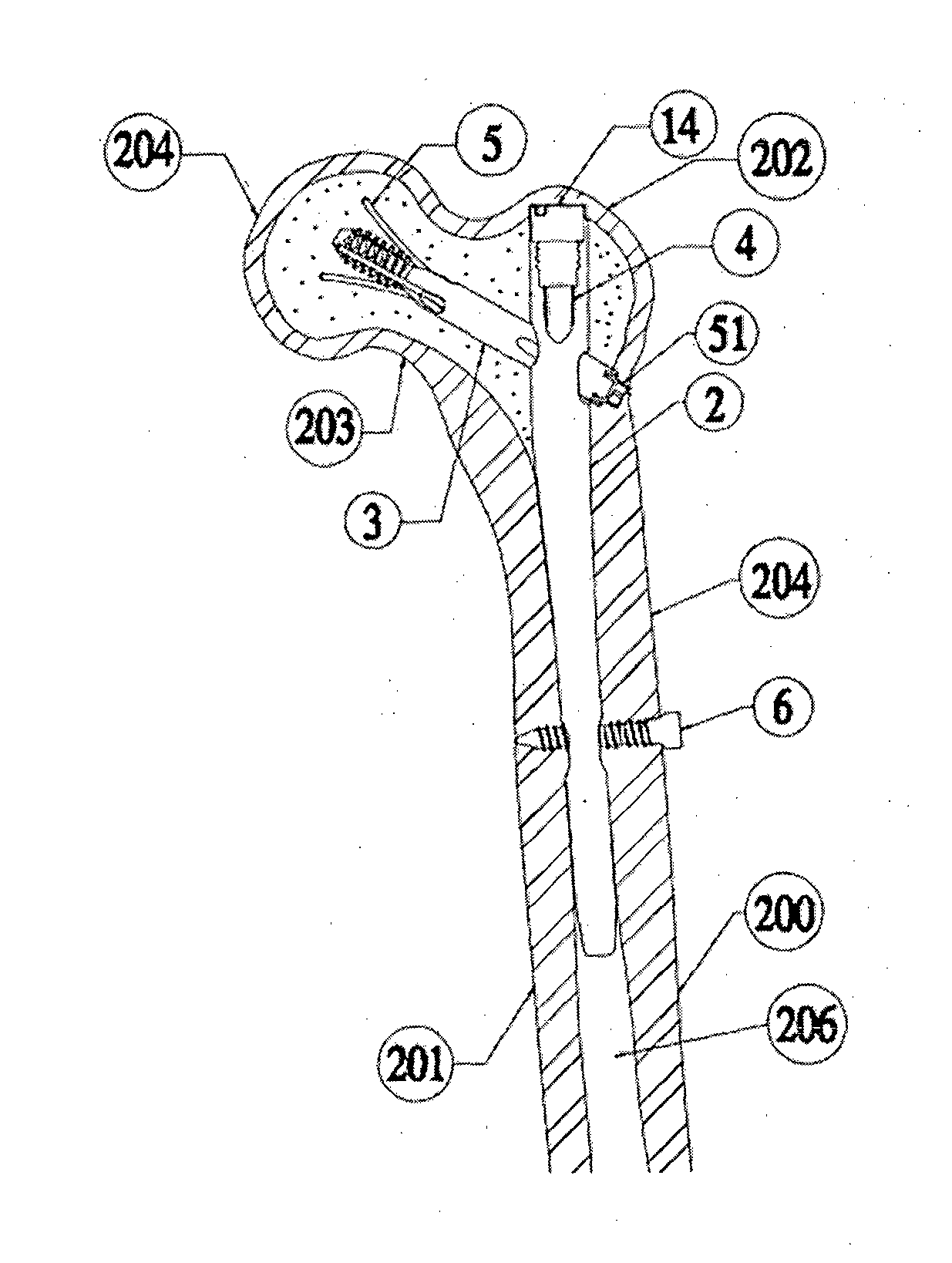 A device for bone support with improved rotational stability