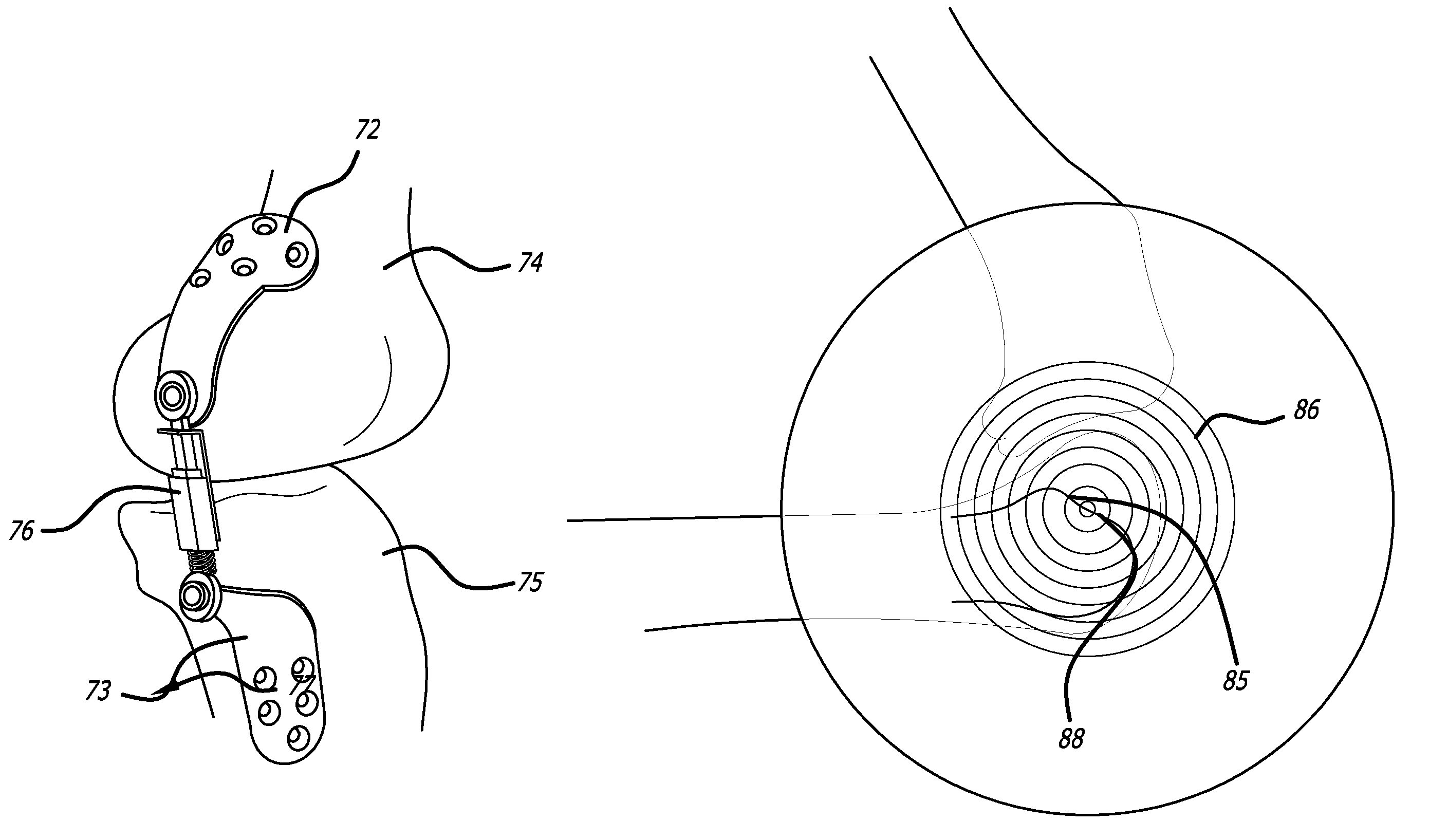 Extra-articular implantable mechanical energy absorbing systems and implantation method