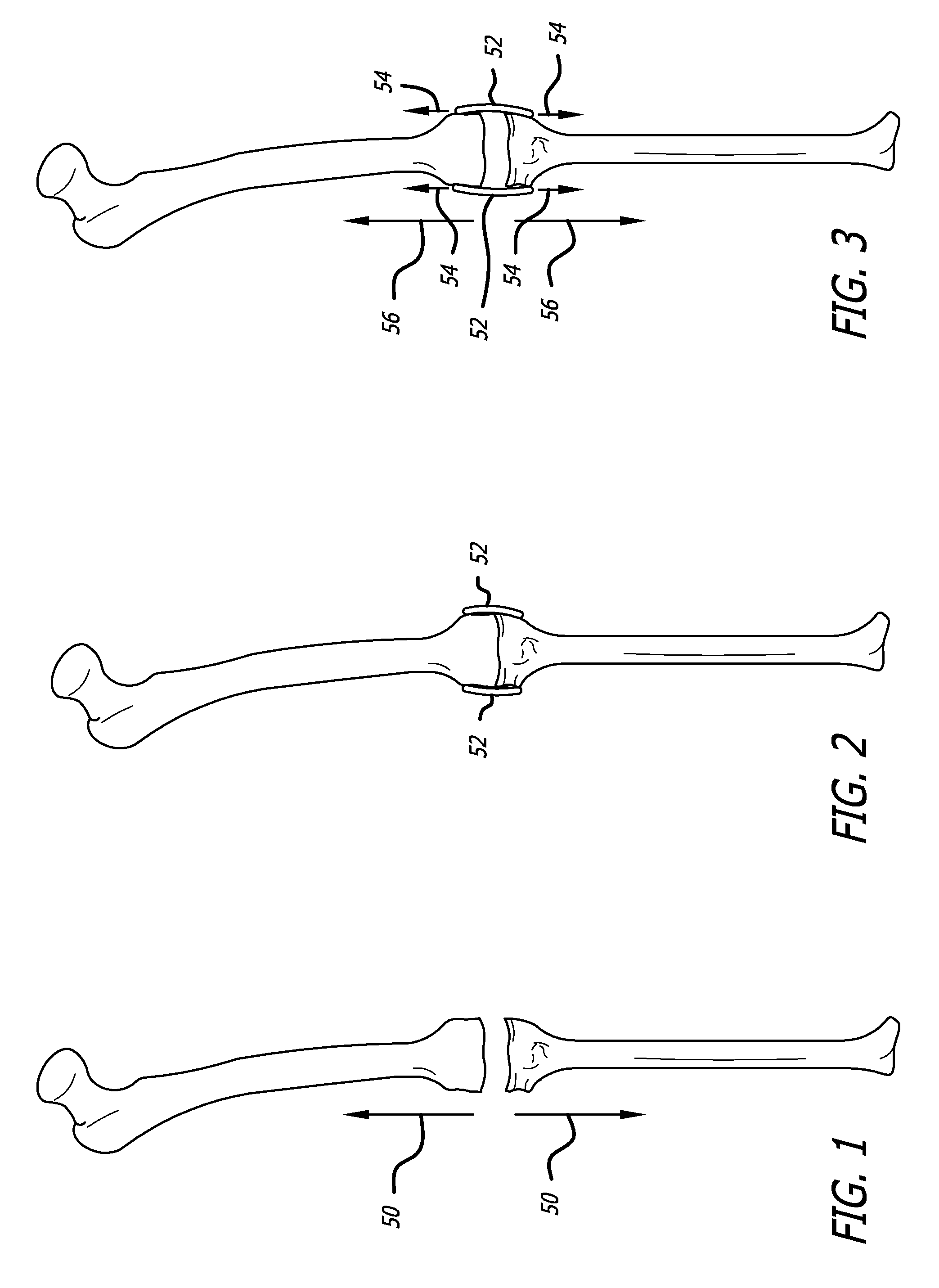 Extra-articular implantable mechanical energy absorbing systems and implantation method