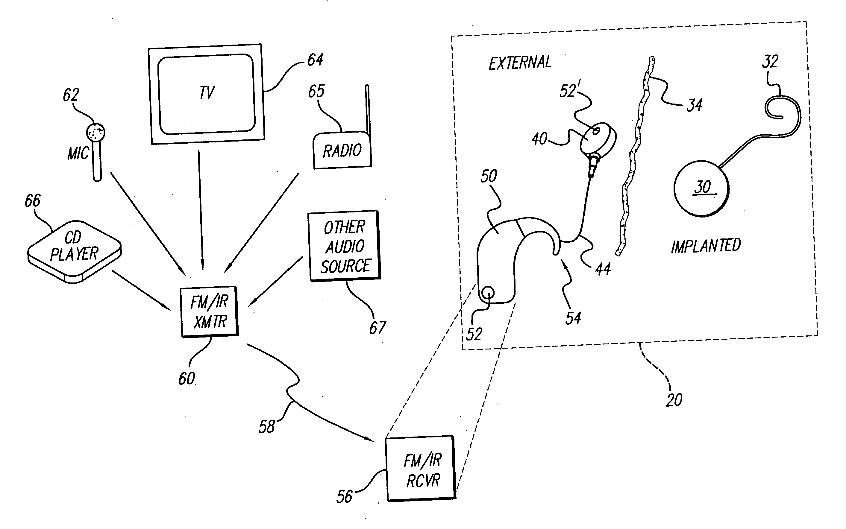 Assistive listening technology integrated into a Behind-The-Ear sound processor