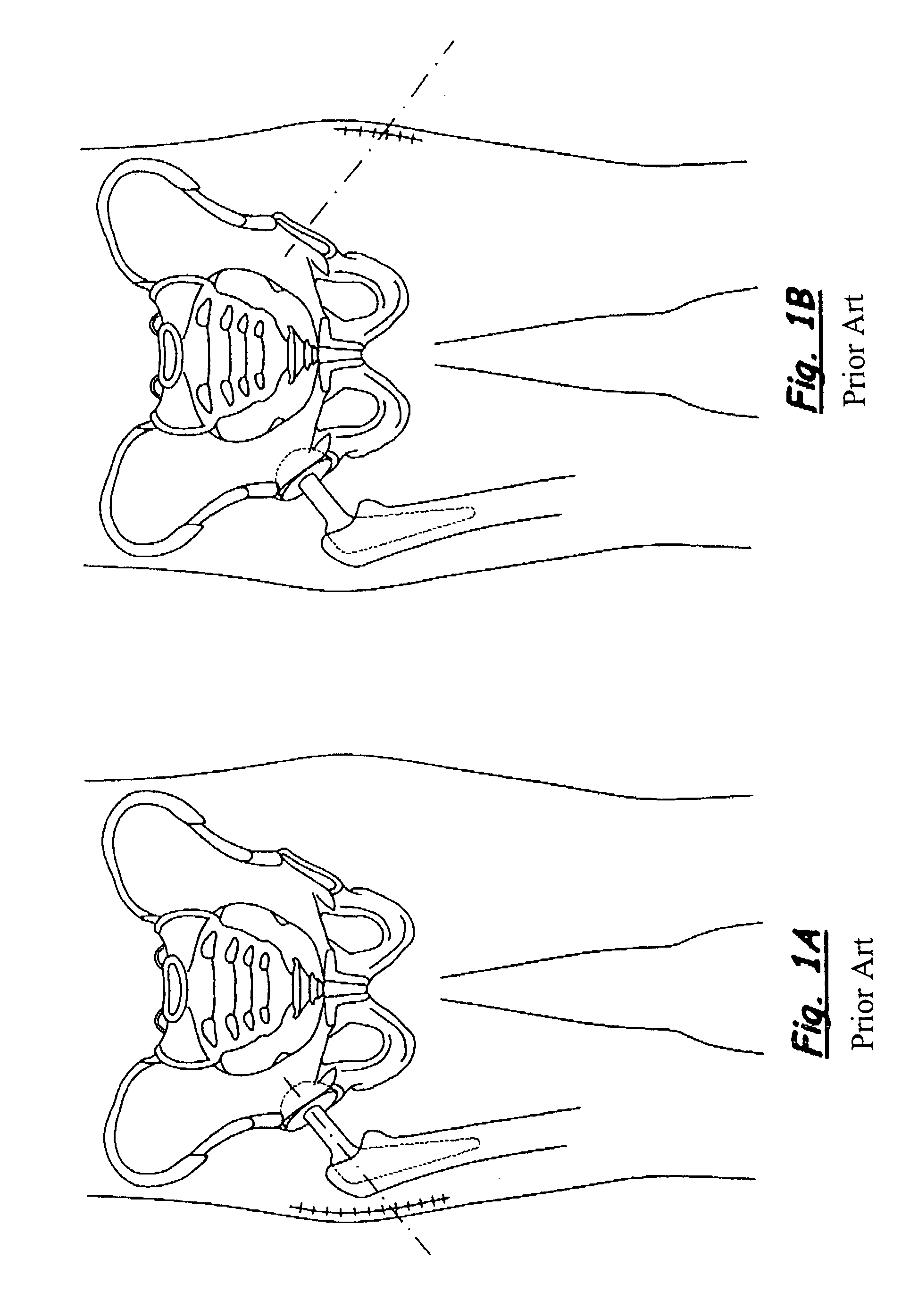 Expandable surgical reaming tool