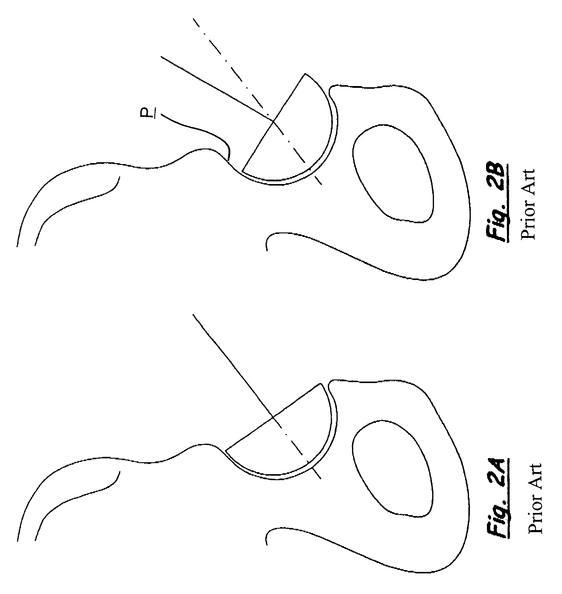 Expandable surgical reaming tool