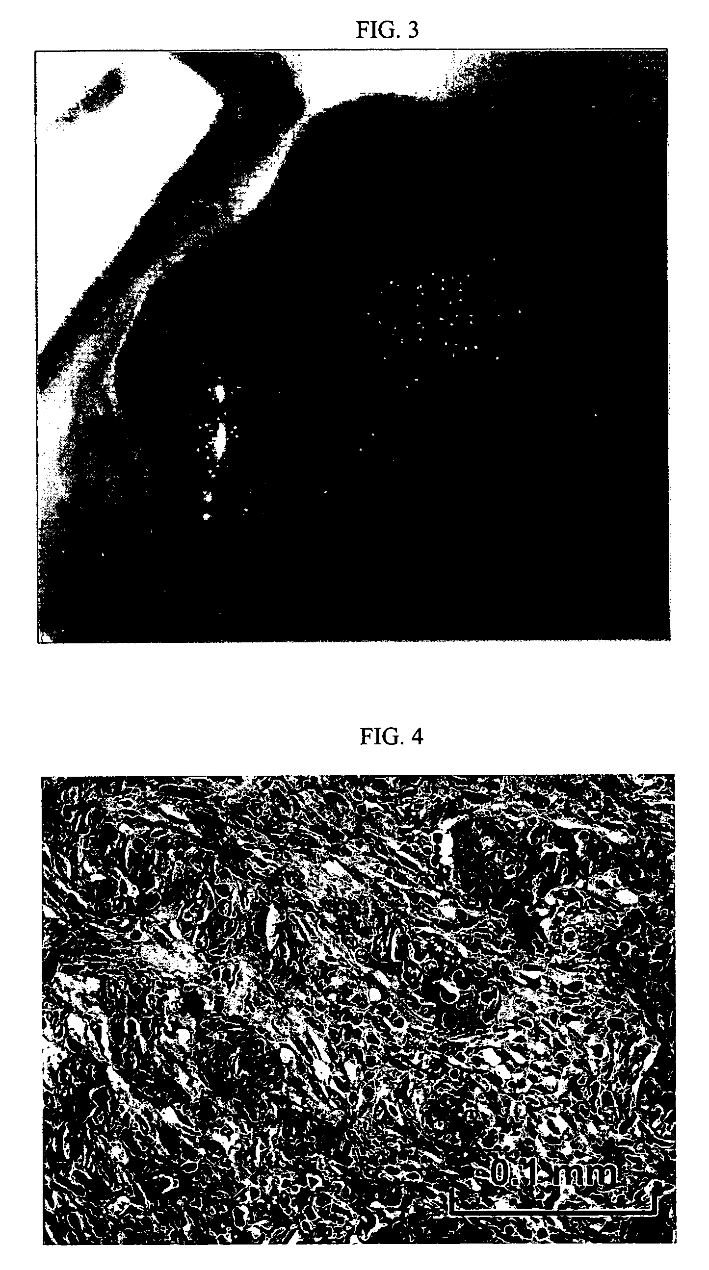 Reconstituted human breast tumor model