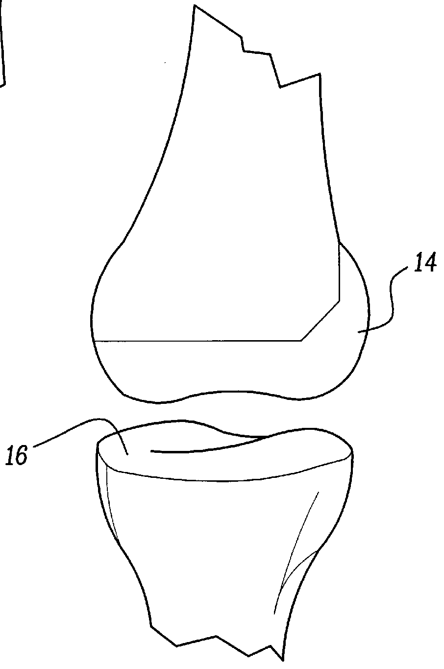 Method of implanting a uni-condylar knee prosthesis