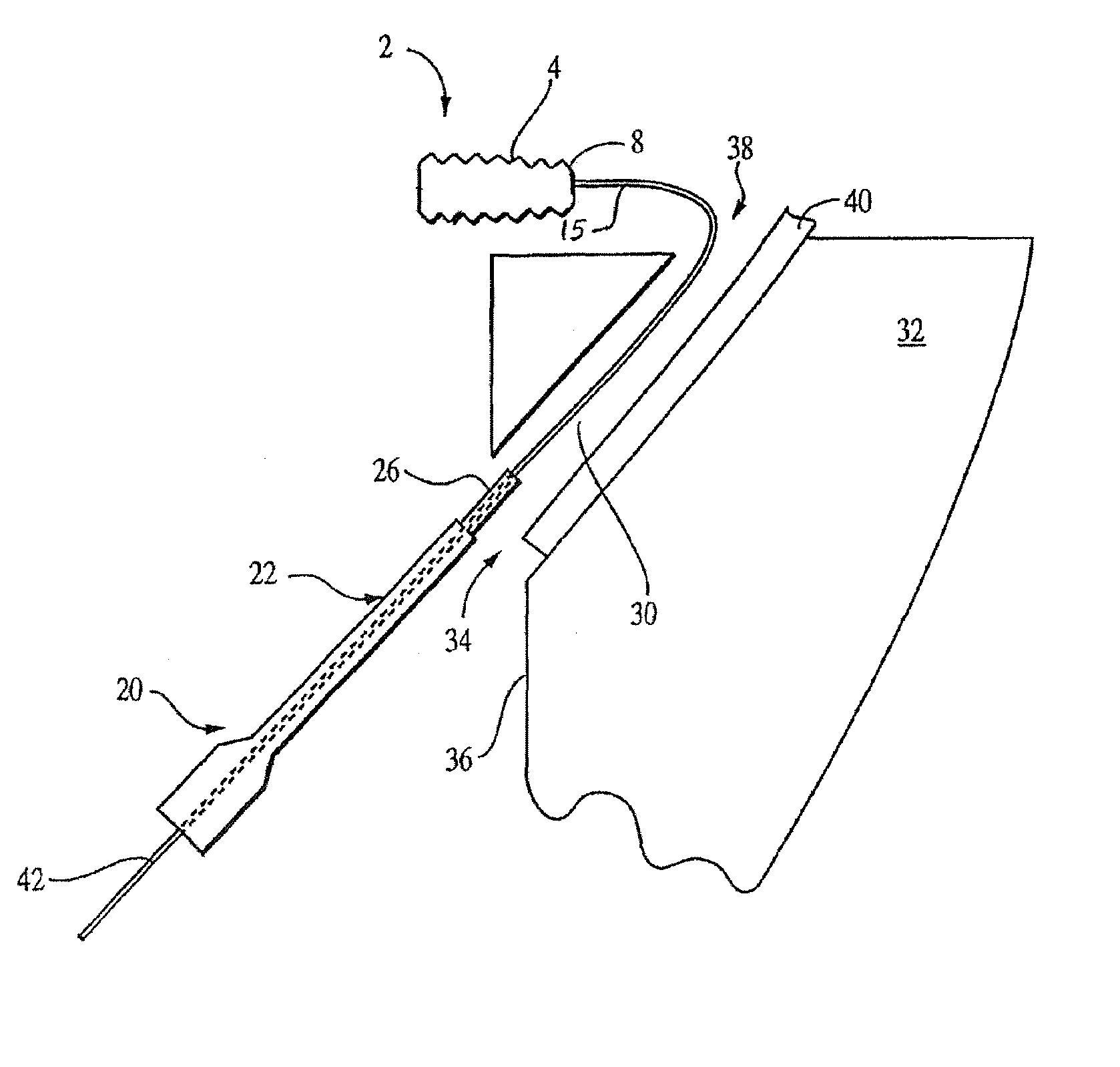 Retrograde fixation technique with insert-molded interference screw