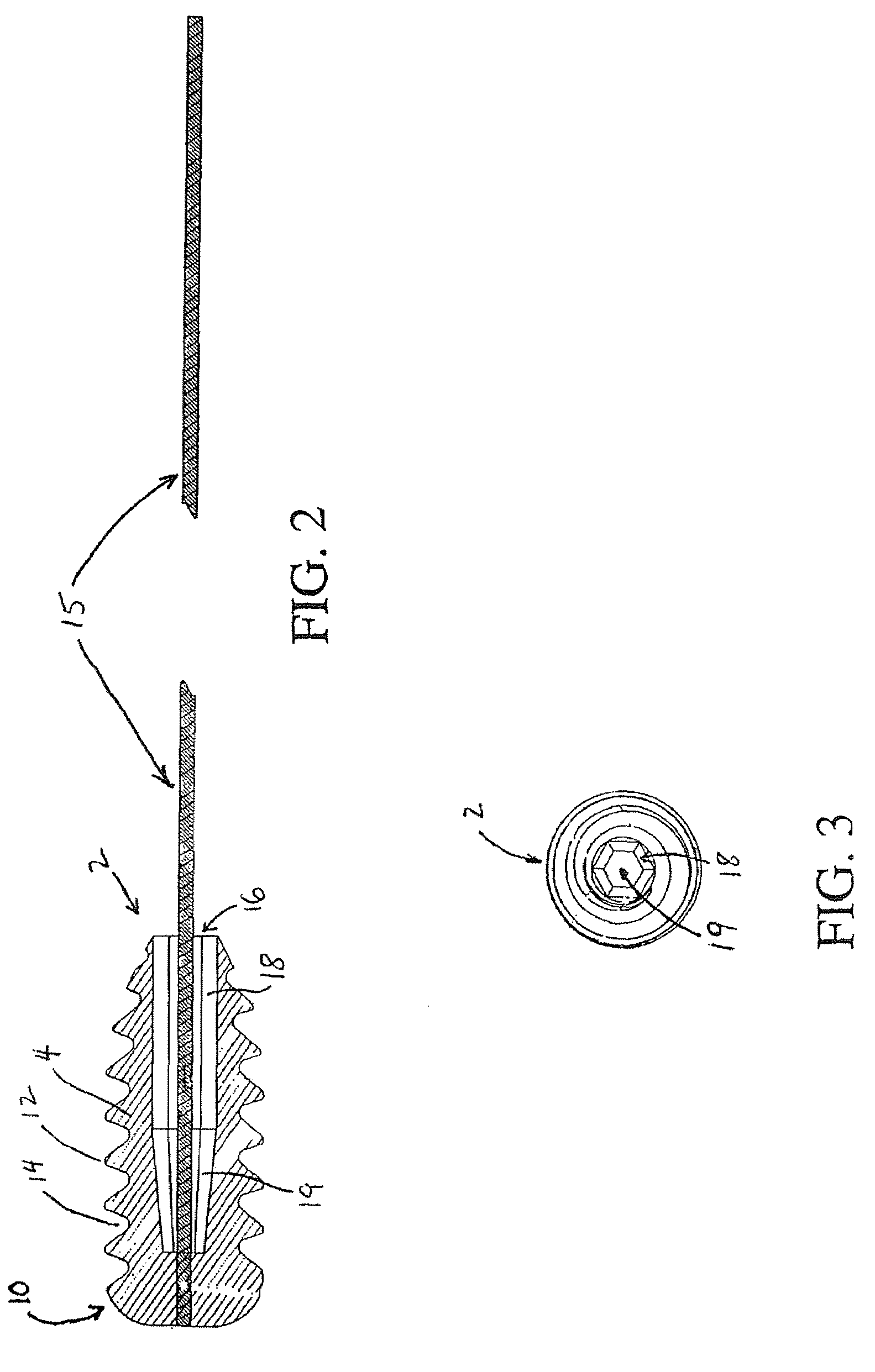 Retrograde fixation technique with insert-molded interference screw