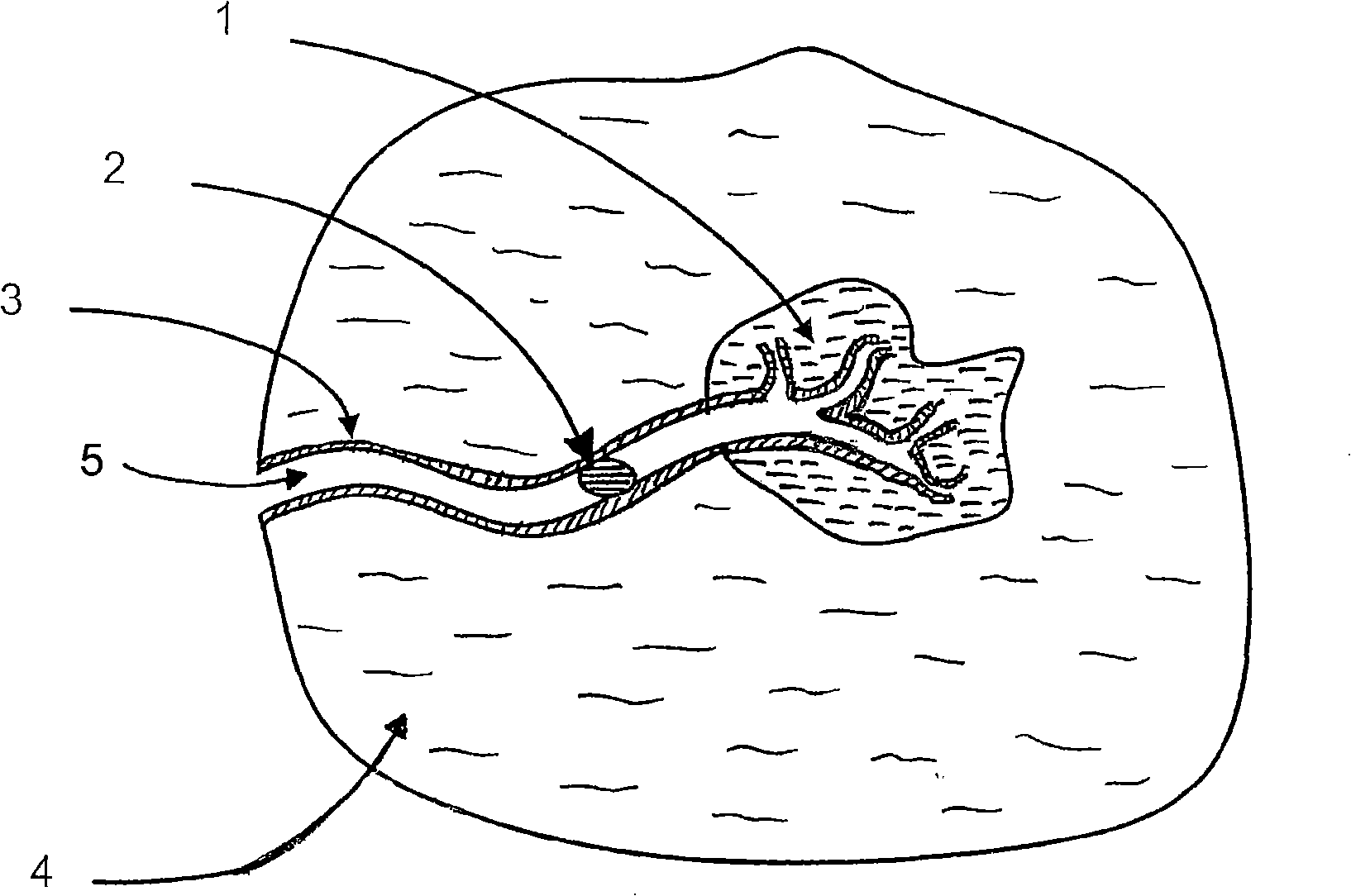 Vessel sealing device and methods