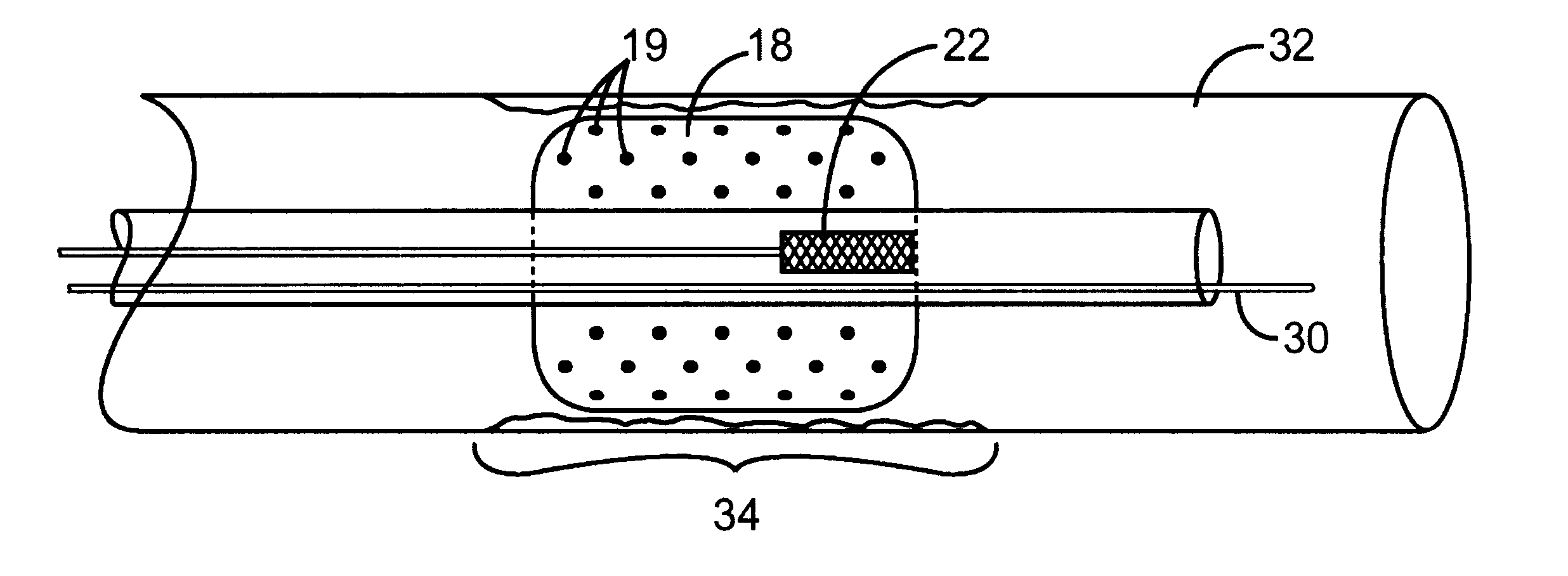 Combination x-ray radiation and drug delivery devices and methods for inhibiting hyperplasia