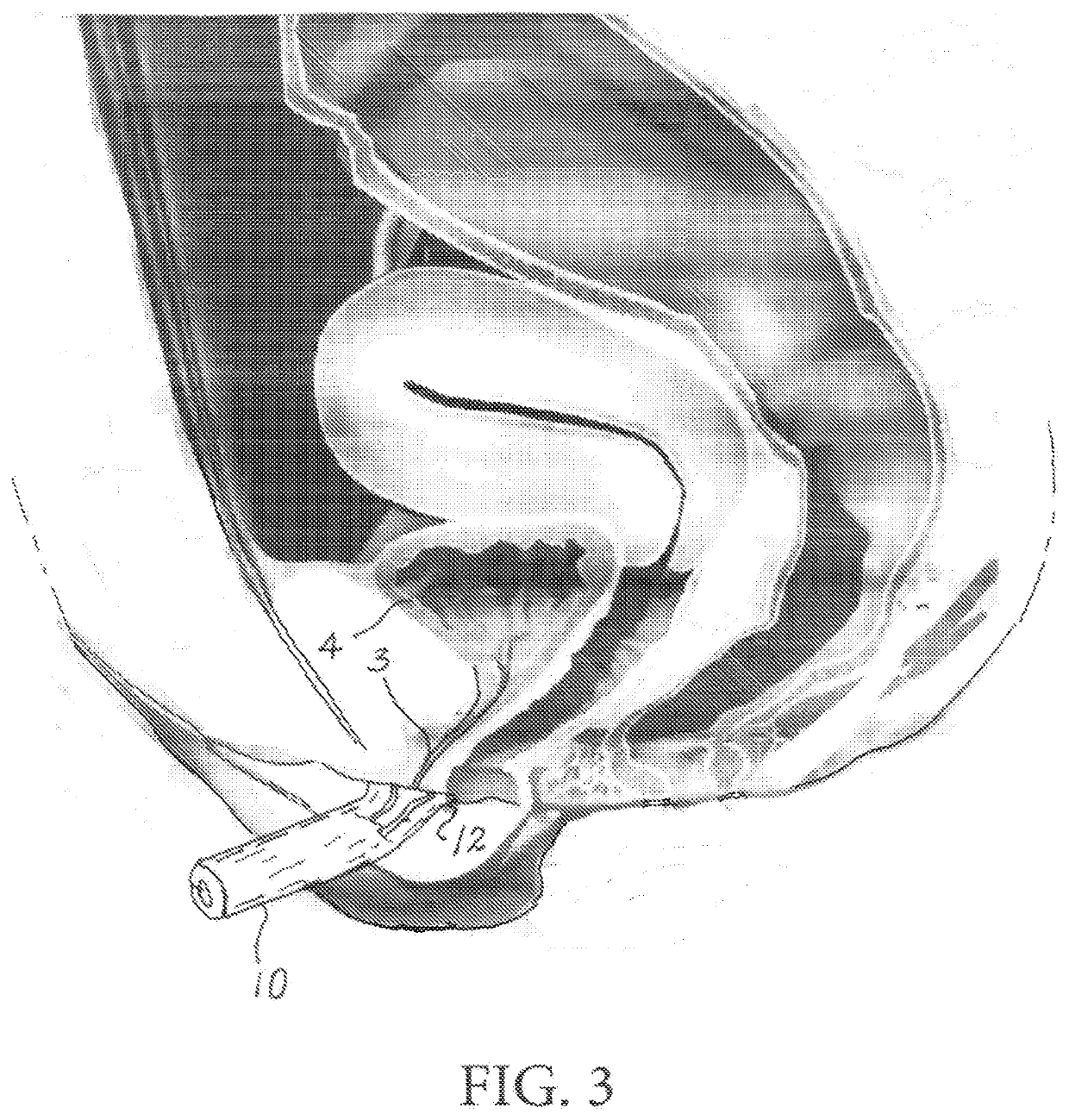 Automated collection and analysis of body fluids