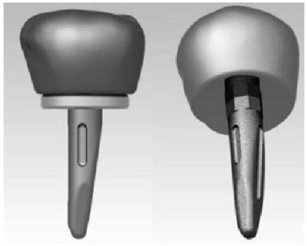 Customized radial head prosthesis based on 3D anatomy of the proximal radius of the unaffected side