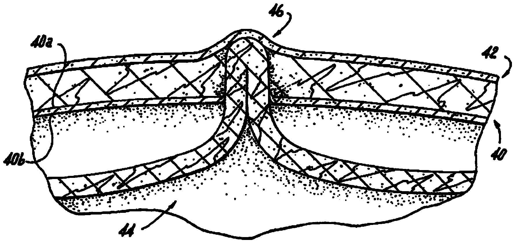 Hernia repair system