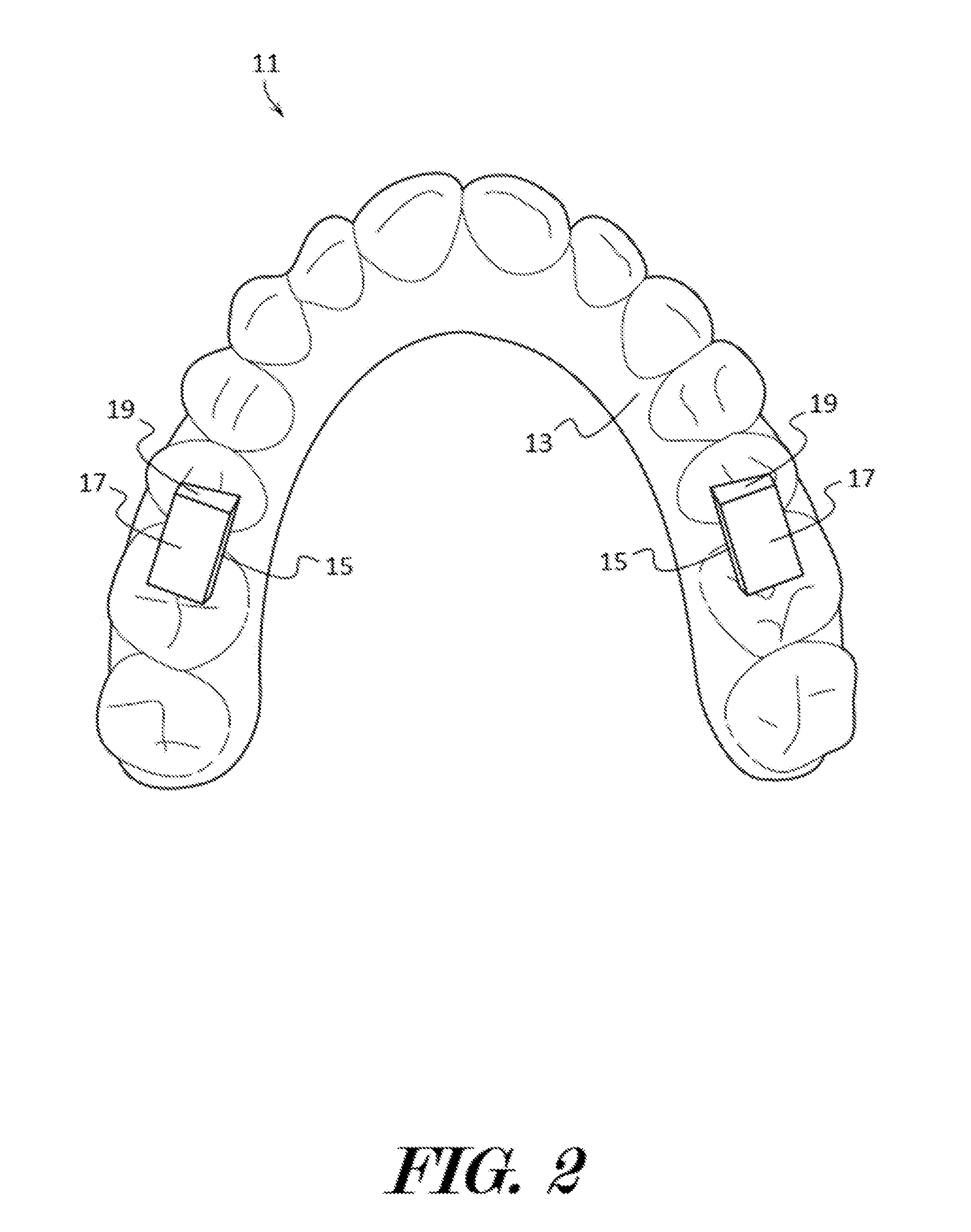 Oral apparatuses and methods for mandibular jaw manipulation