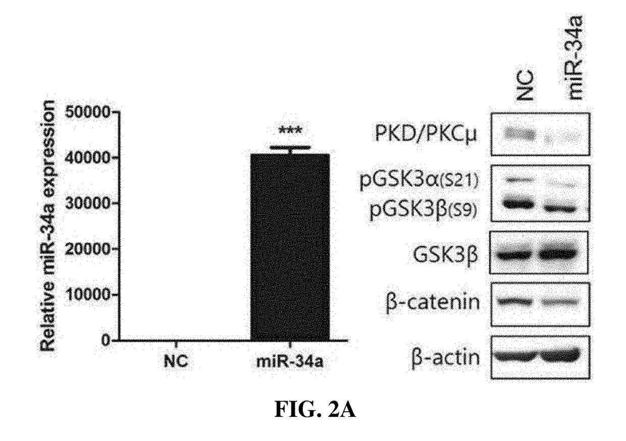 Therapeutic compositions for breast cancer containing protein kinase D1 inhibitor