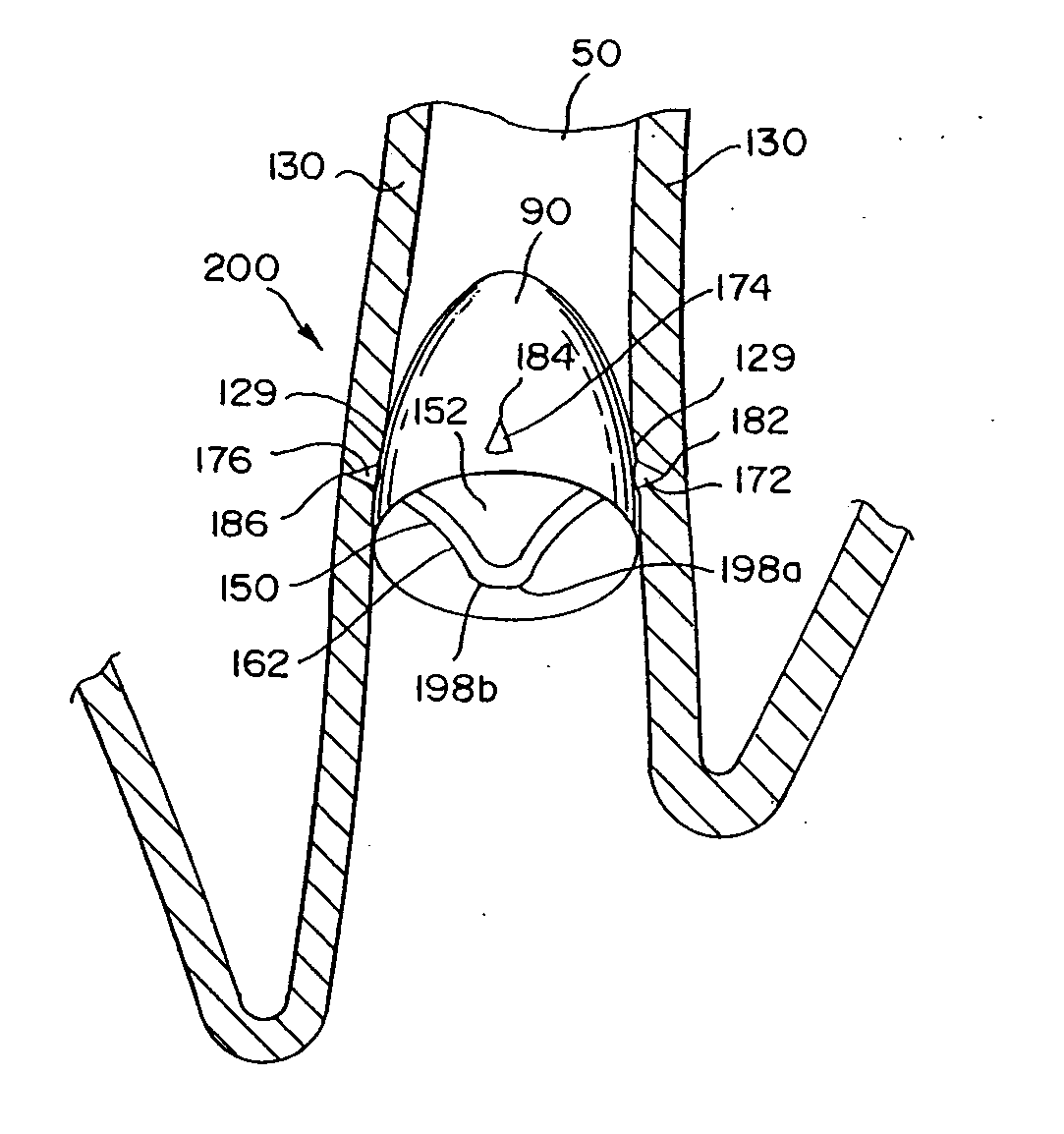 Removable anchored lung volume reduction device and methods