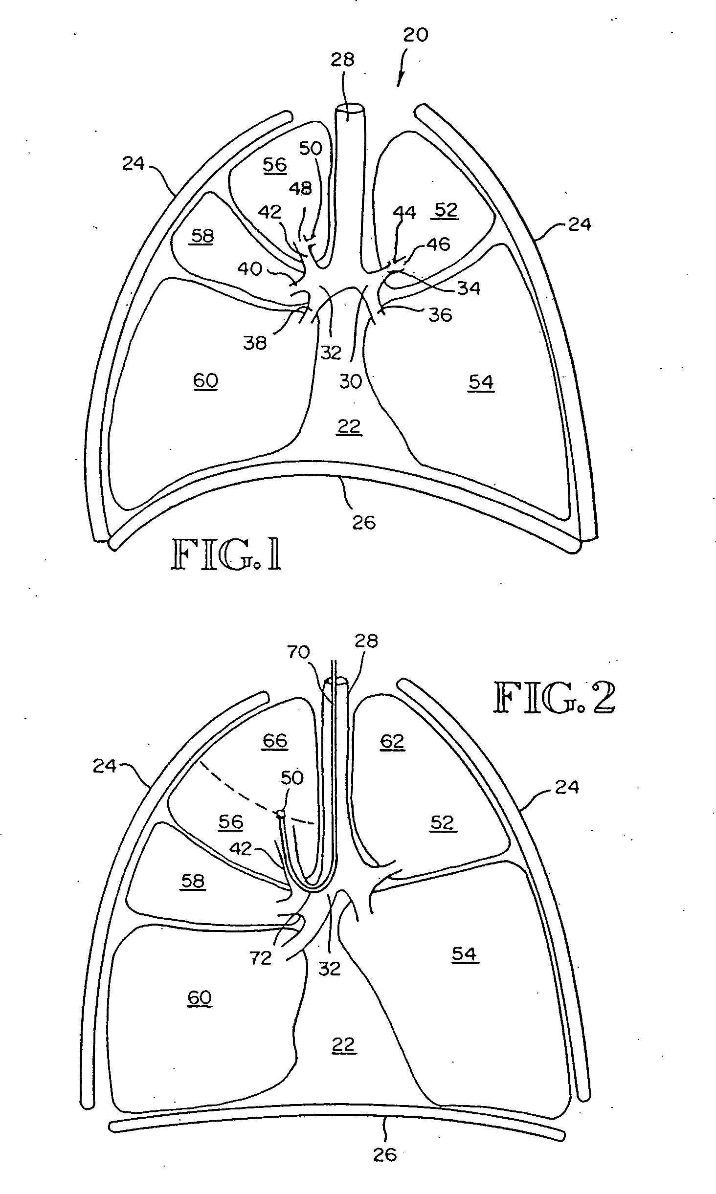 Removable anchored lung volume reduction device and methods