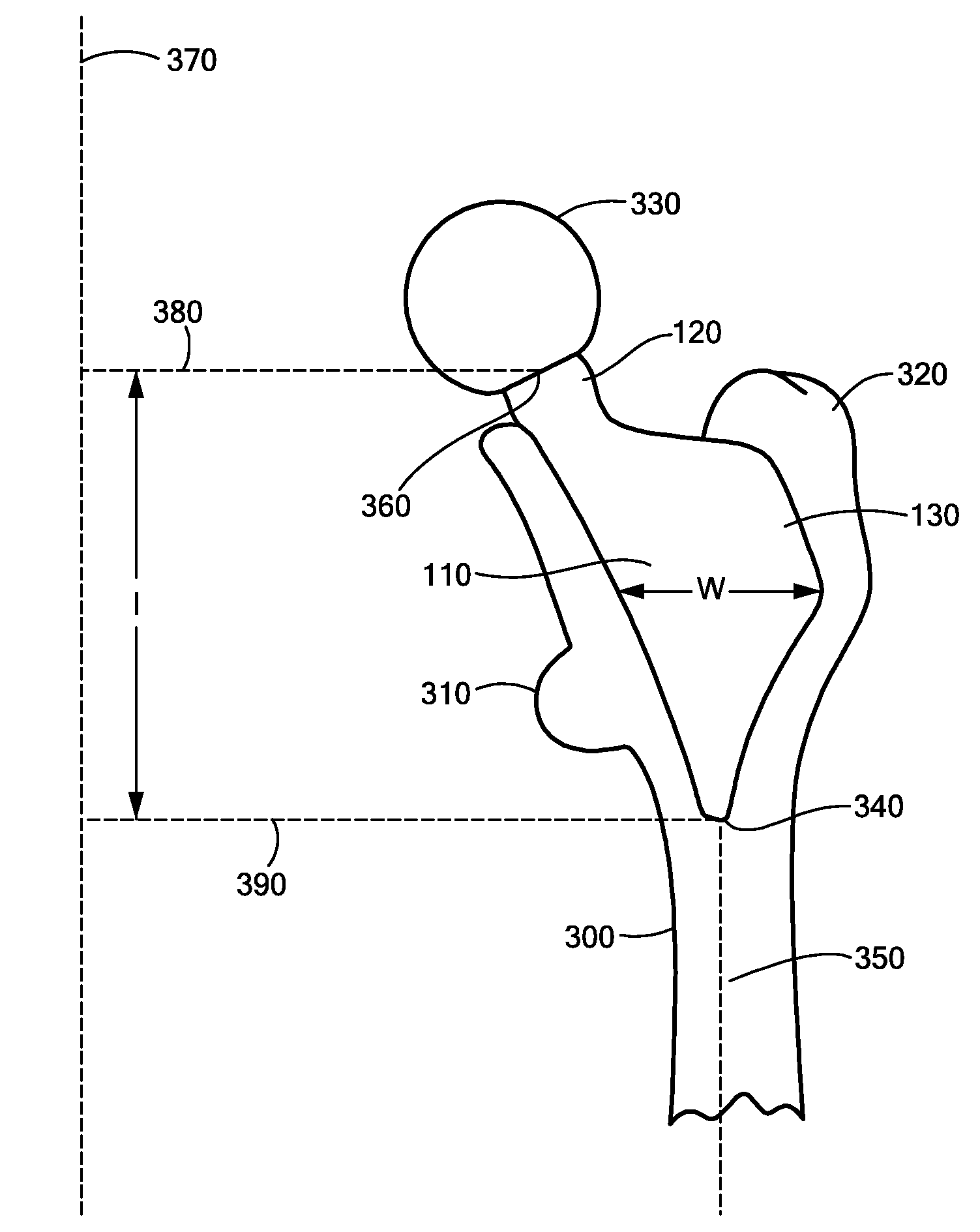 Proximally Self-Locking Long Bone Prosthesis