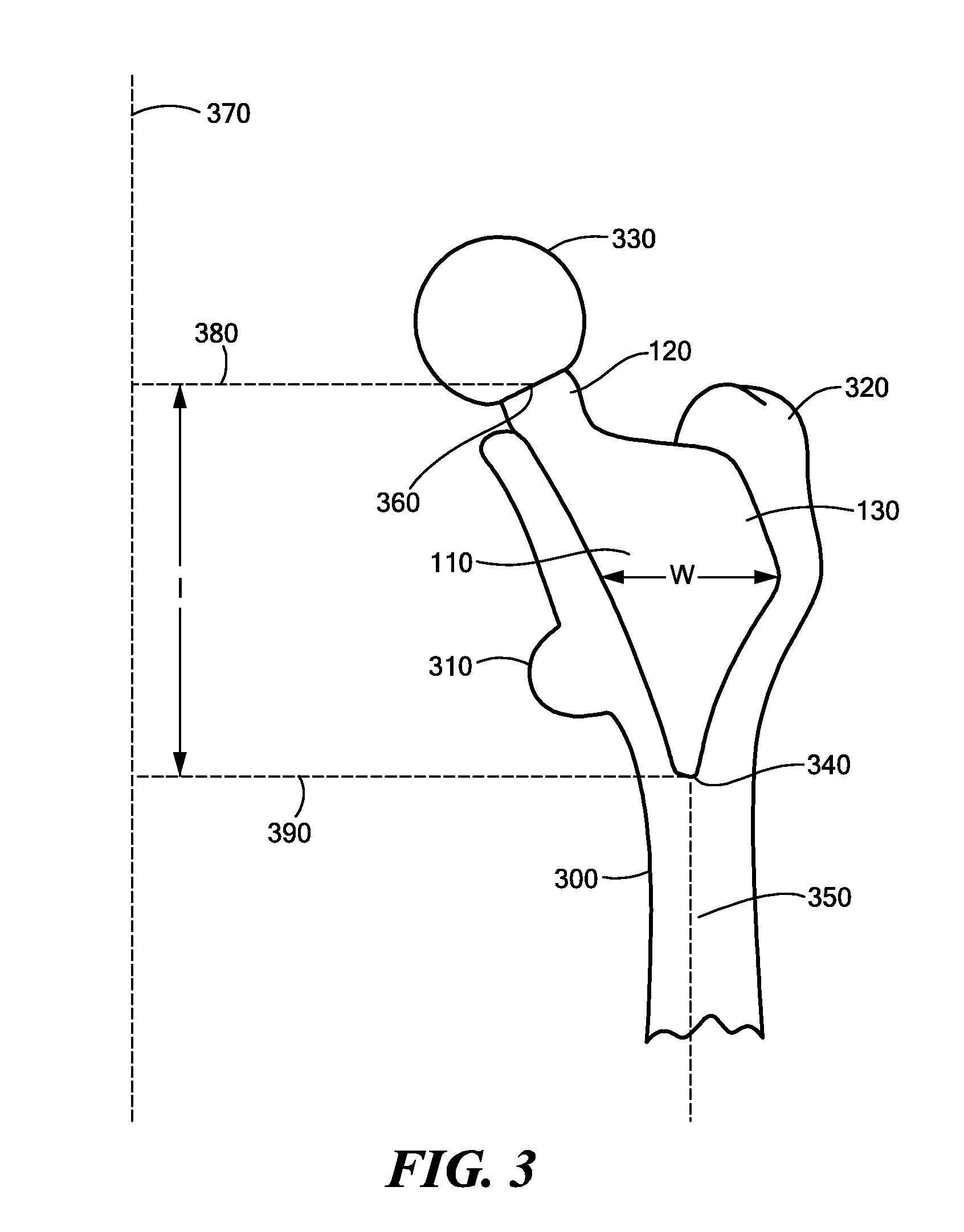 Proximally Self-Locking Long Bone Prosthesis