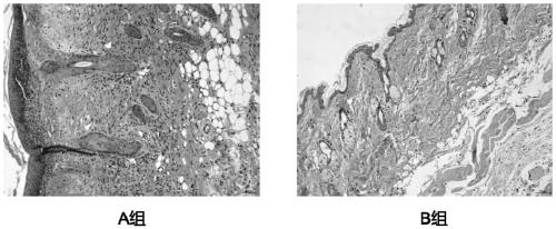 Application of quinine and pharmaceutically acceptable salts thereof to preparation of drug for treating AD (atopic dermatitis)