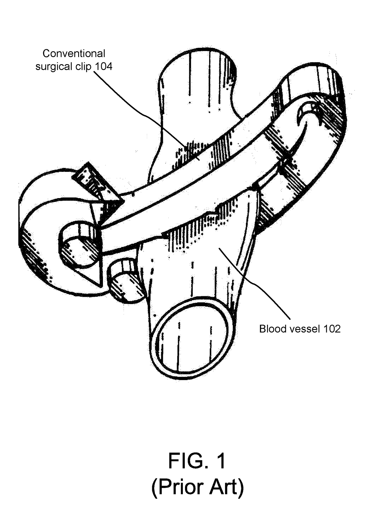 Surgical ligation clip