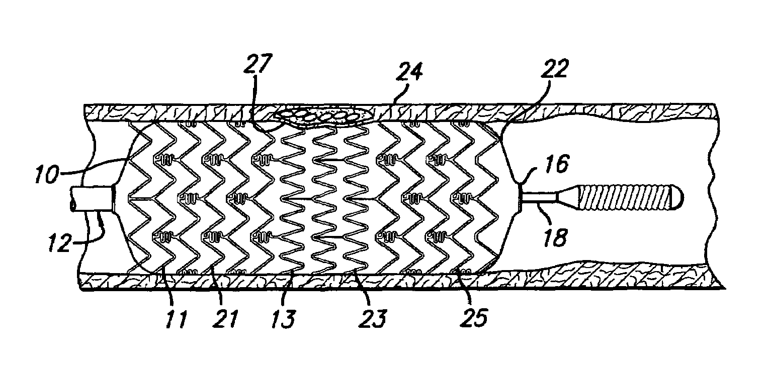 Stent for treating vulnerable plaque