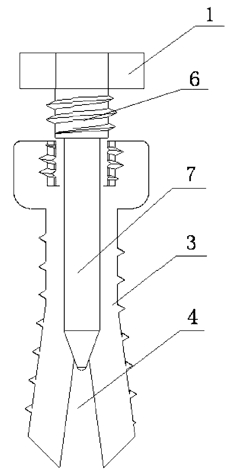 Expansive orthodontic anchorage implant