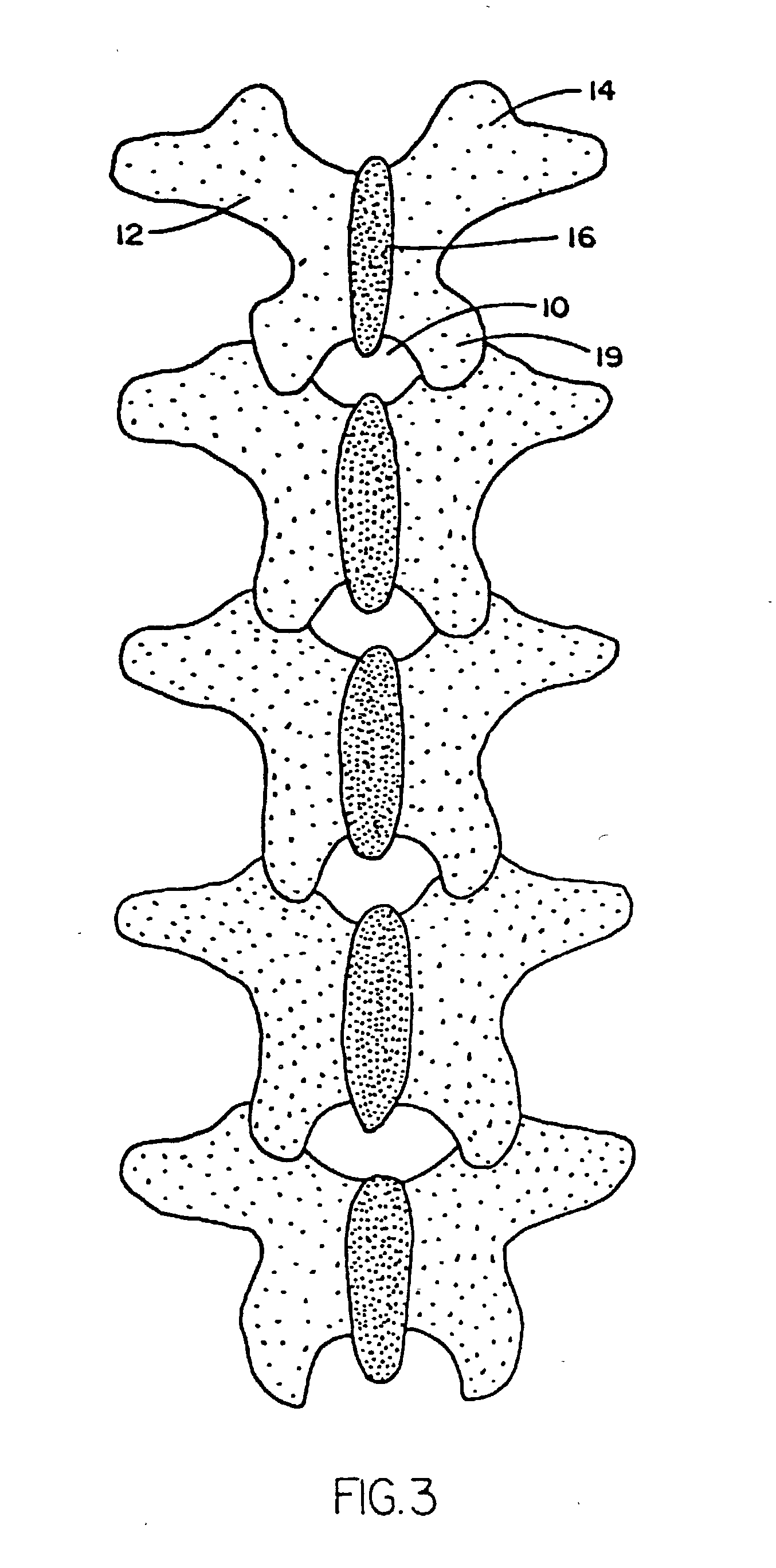 Adjustable tandem connectors for corrective devices for the spinal column and other bones and joints