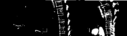 3D vertebra CT image active contour segmentation method fusing weighted random forest