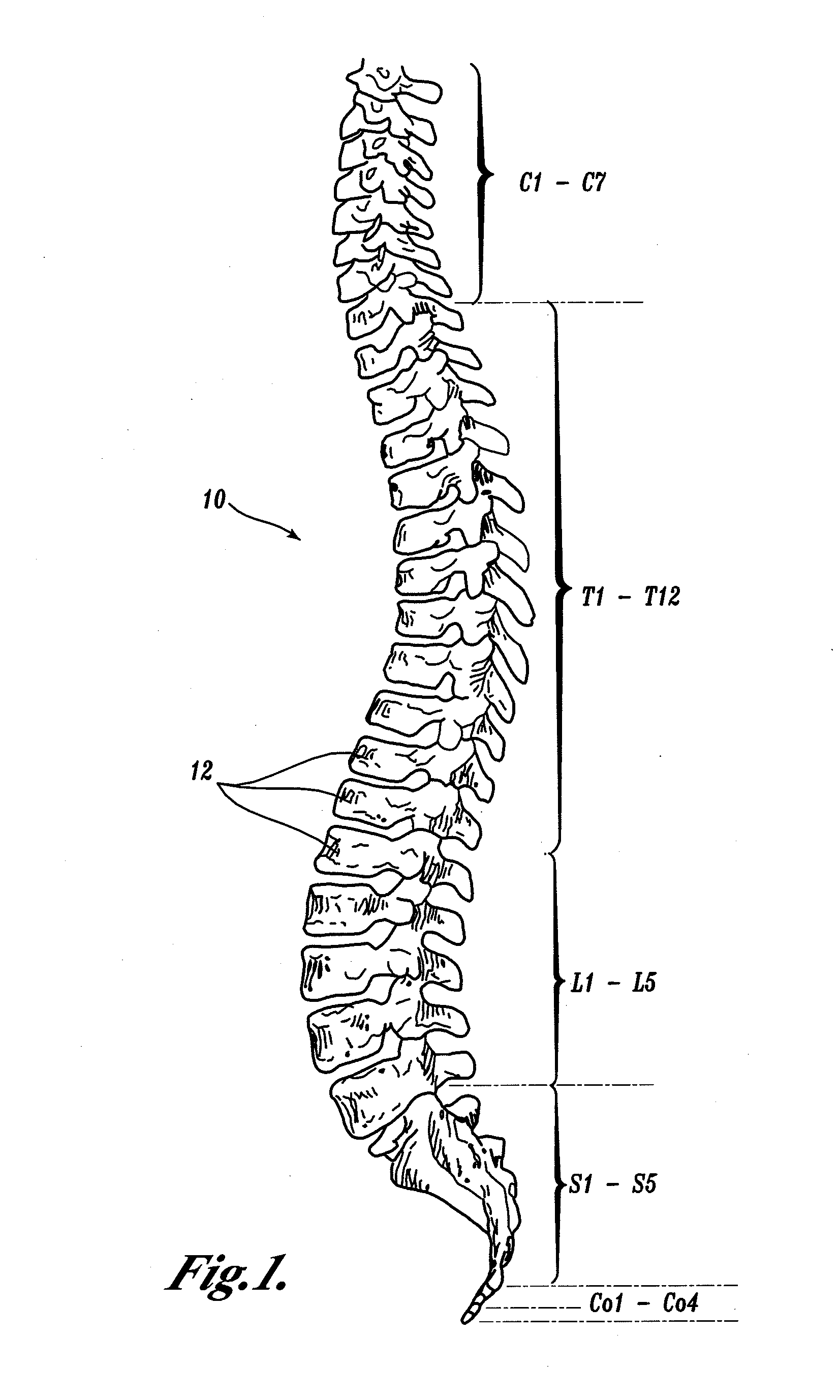 Polyaxial adjustment of facet joint prostheses