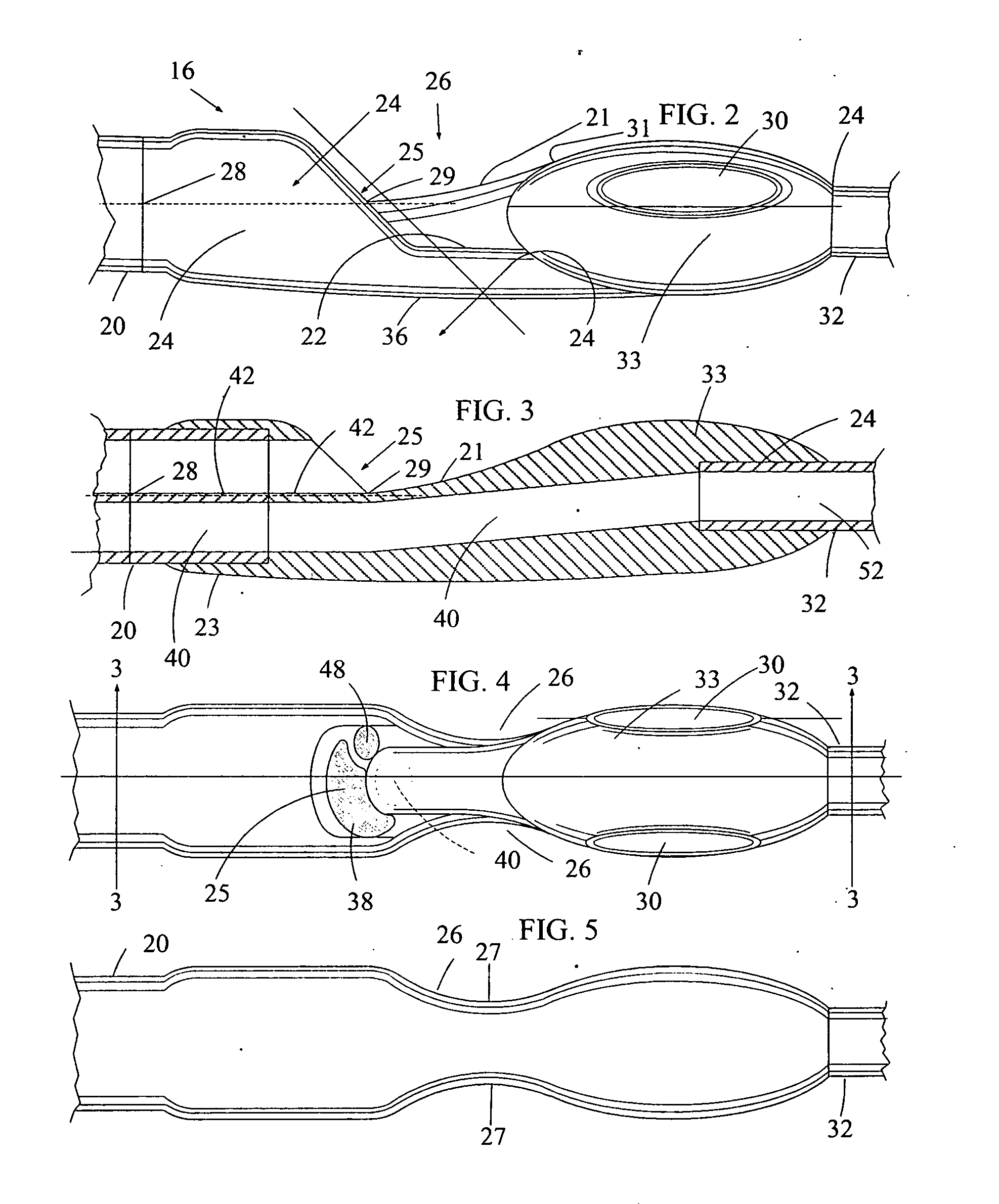 Jejunal feeding catheter