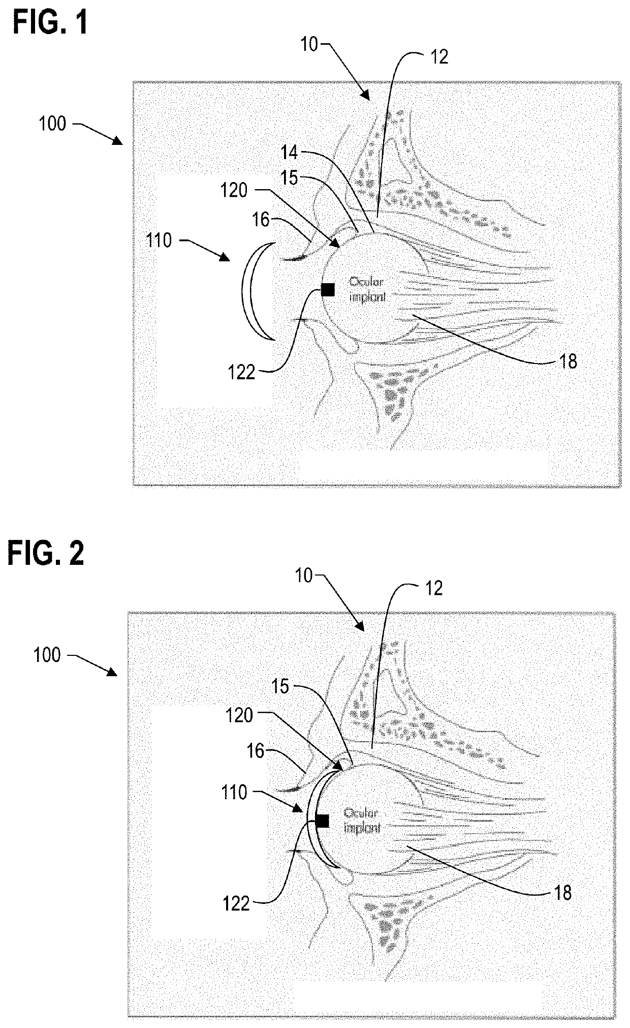 Ocular prosthesis with display device