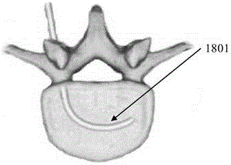 A device used to create a cavity in a vertebral body