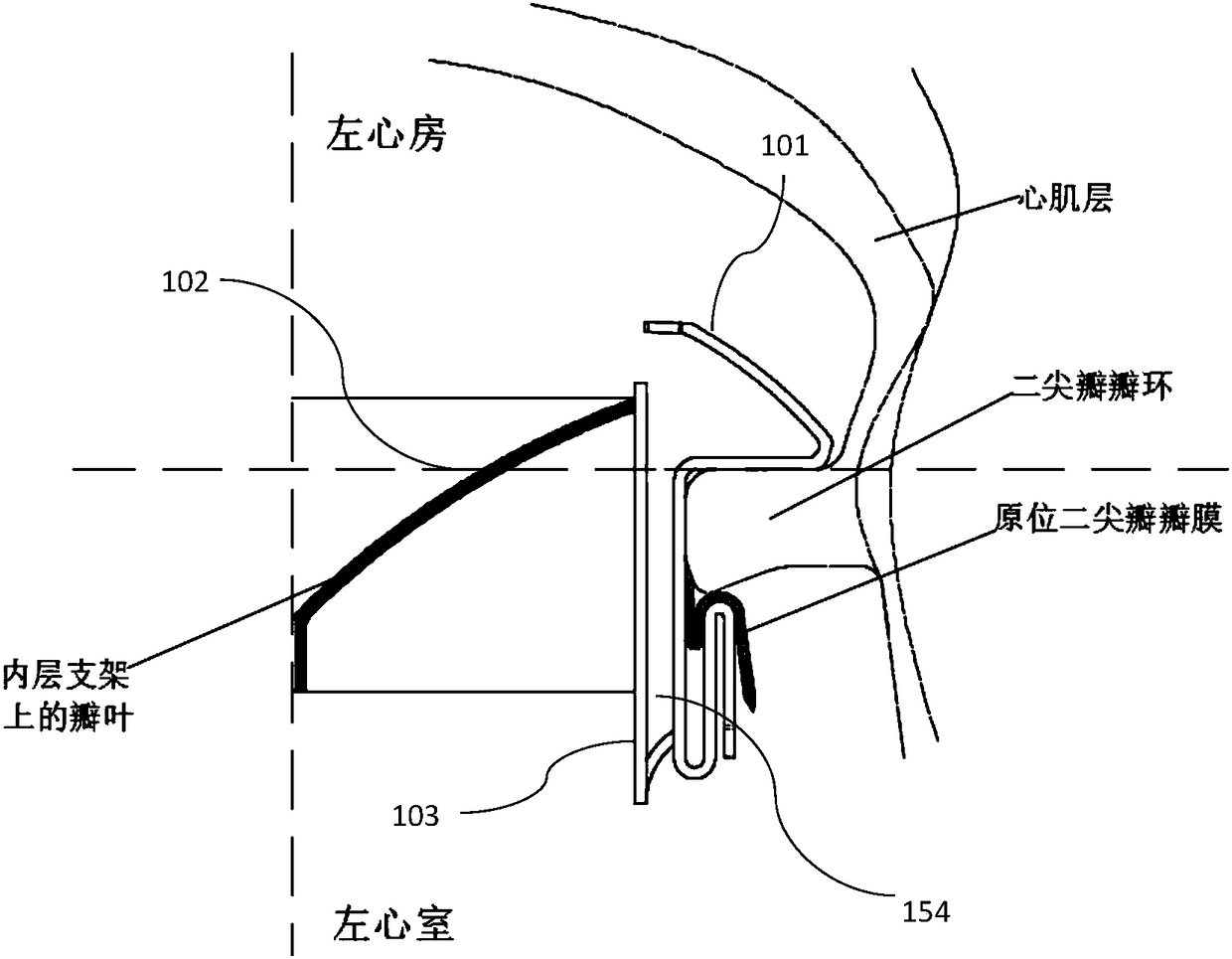 Transapical implantable mitral valve device