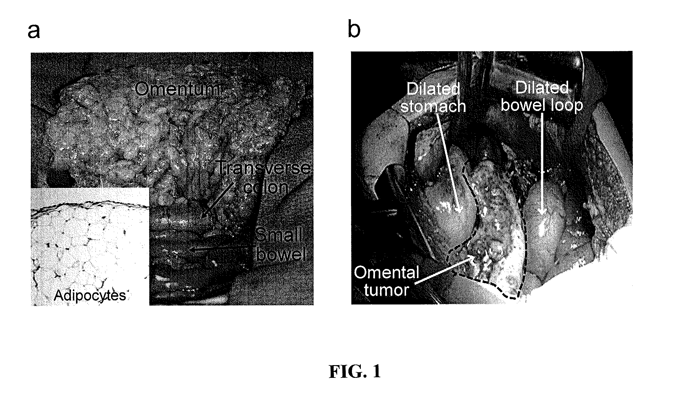 Methods for treating ovarian cancer by inhibiting fatty acid binding proteins